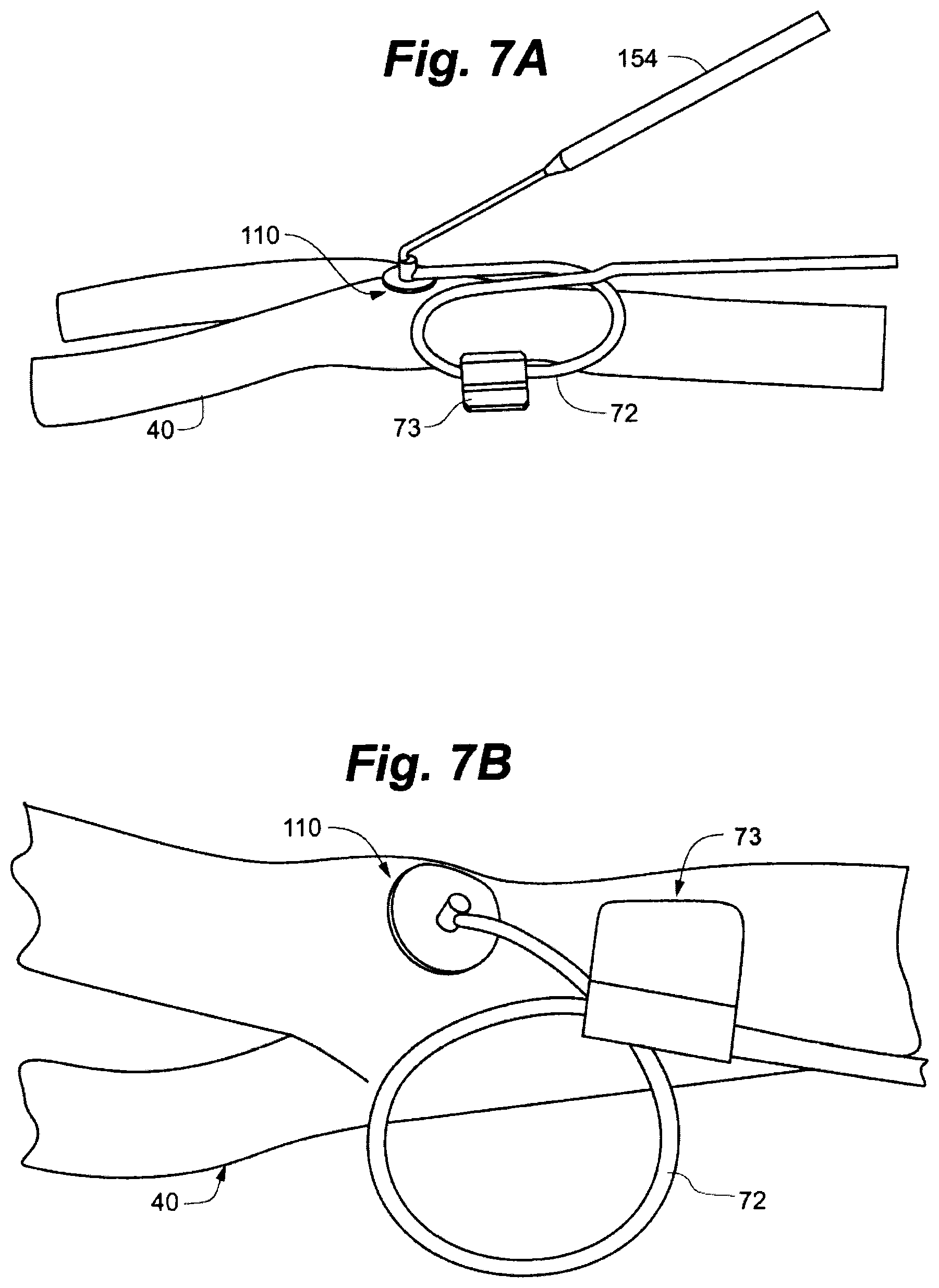 Patent US12496439 Figure 6 – Implant tool and improved electrode design for minimally invasive procedure