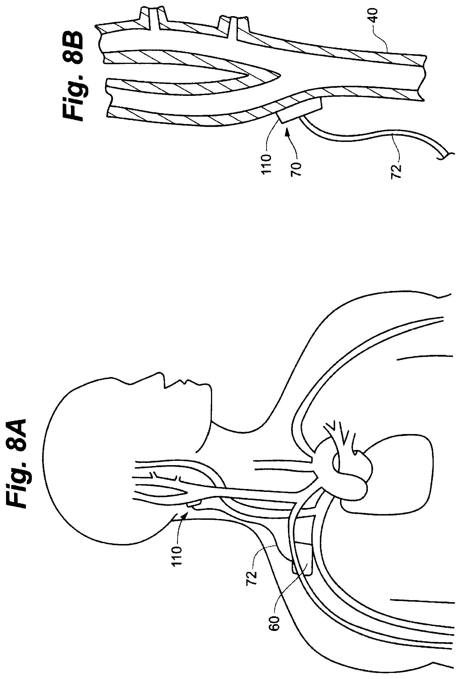 Patent US12496439 Figure 7 – Implant tool and improved electrode design for minimally invasive procedure