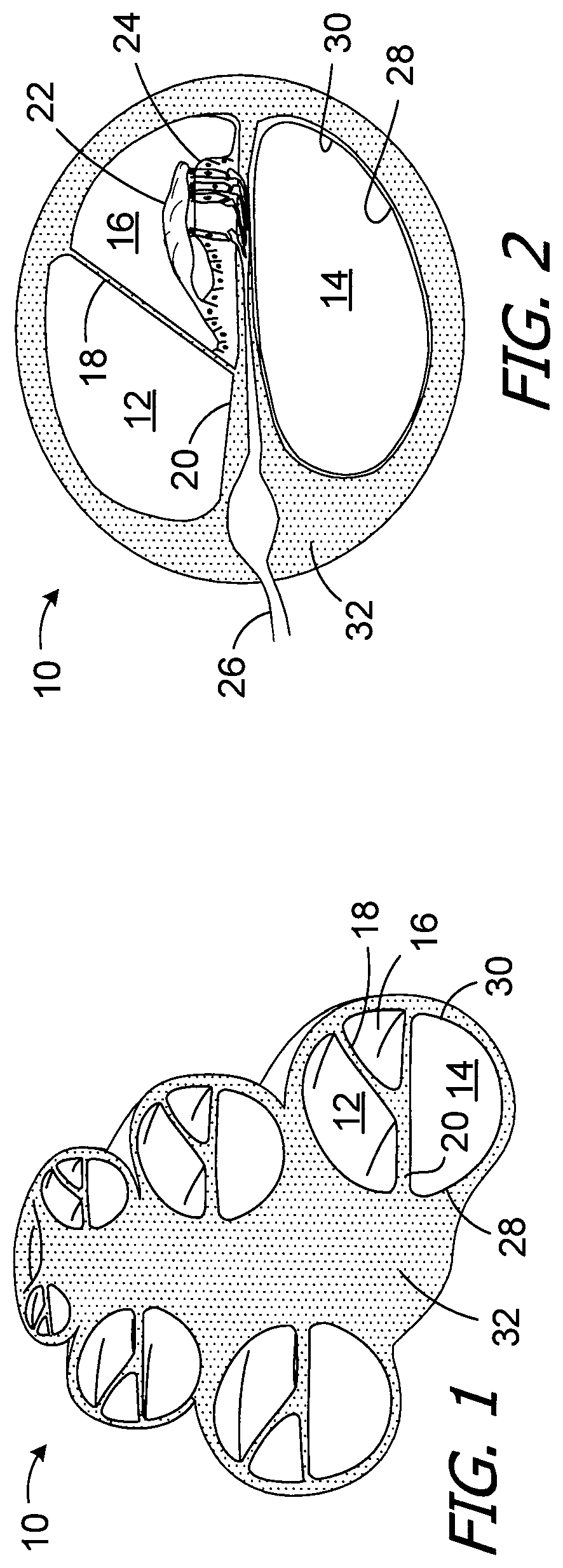Patent US12496440 Figure 1 – Apparatus and methods for making cochlear implant electrode arrays