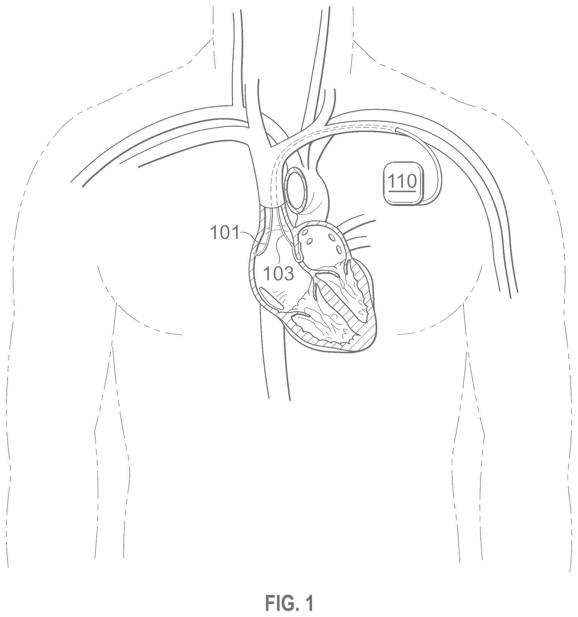 Patent US12496441 Figure 1 – Implantable endovascular, low profile intracardiac left atrial restraining devices for low energy atrial cardioversion, pacing and sensing