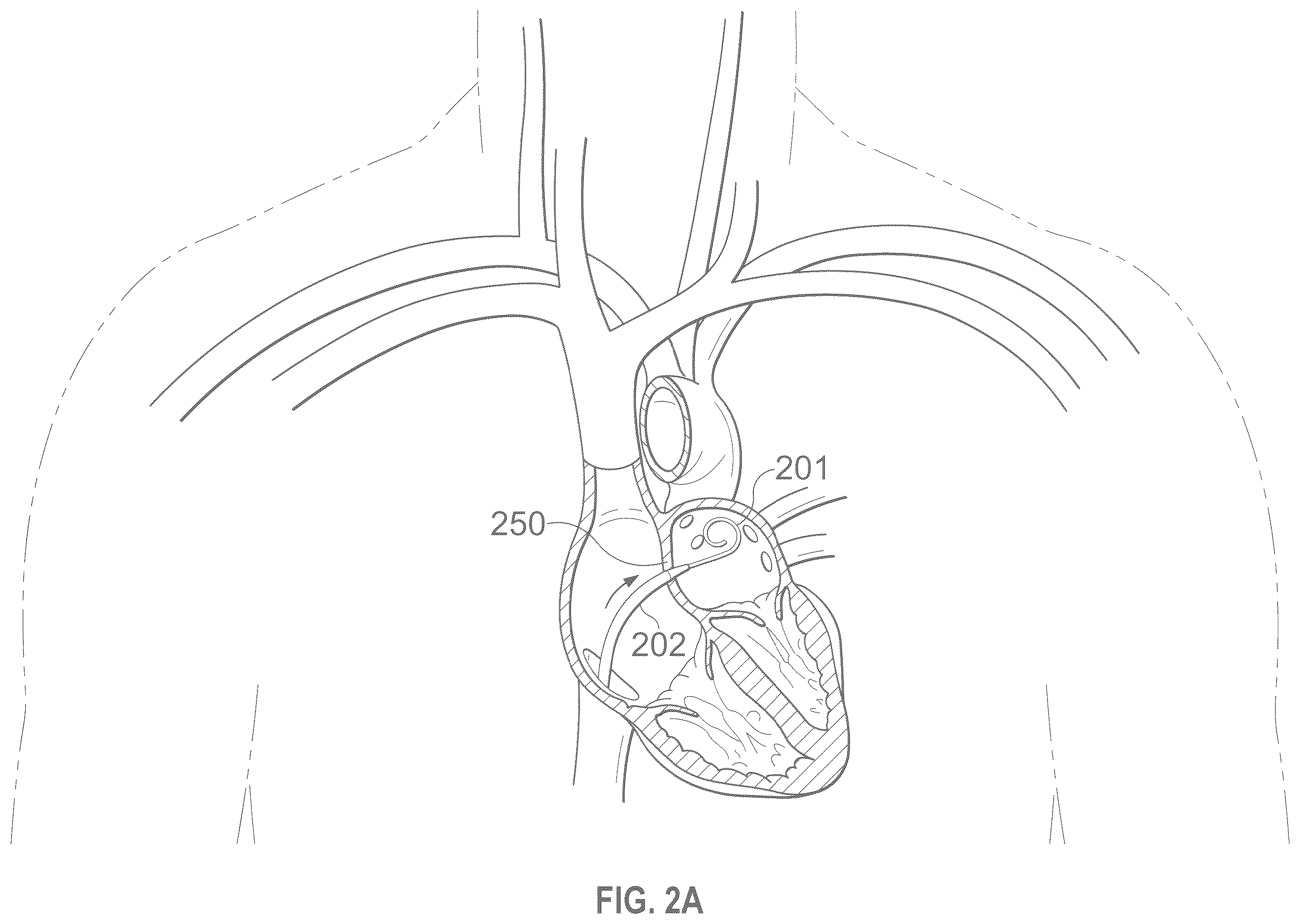Patent US12496441 Figure 2 – Implantable endovascular, low profile intracardiac left atrial restraining devices for low energy atrial cardioversion, pacing and sensing