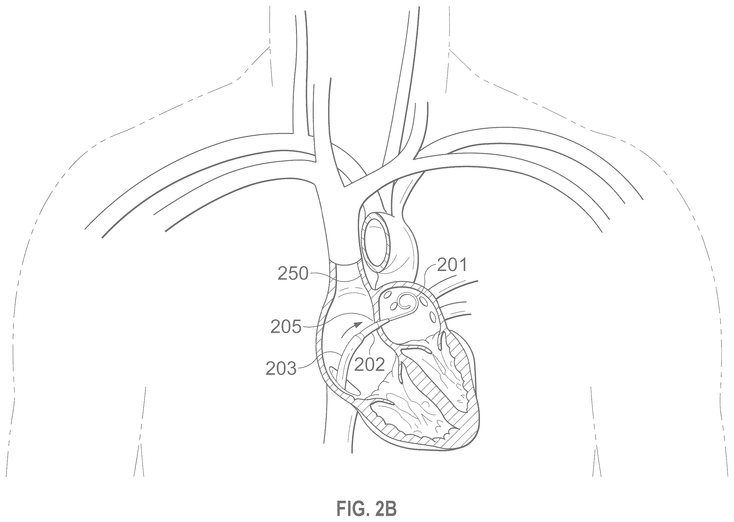 Patent US12496441 Figure 3 – Implantable endovascular, low profile intracardiac left atrial restraining devices for low energy atrial cardioversion, pacing and sensing
