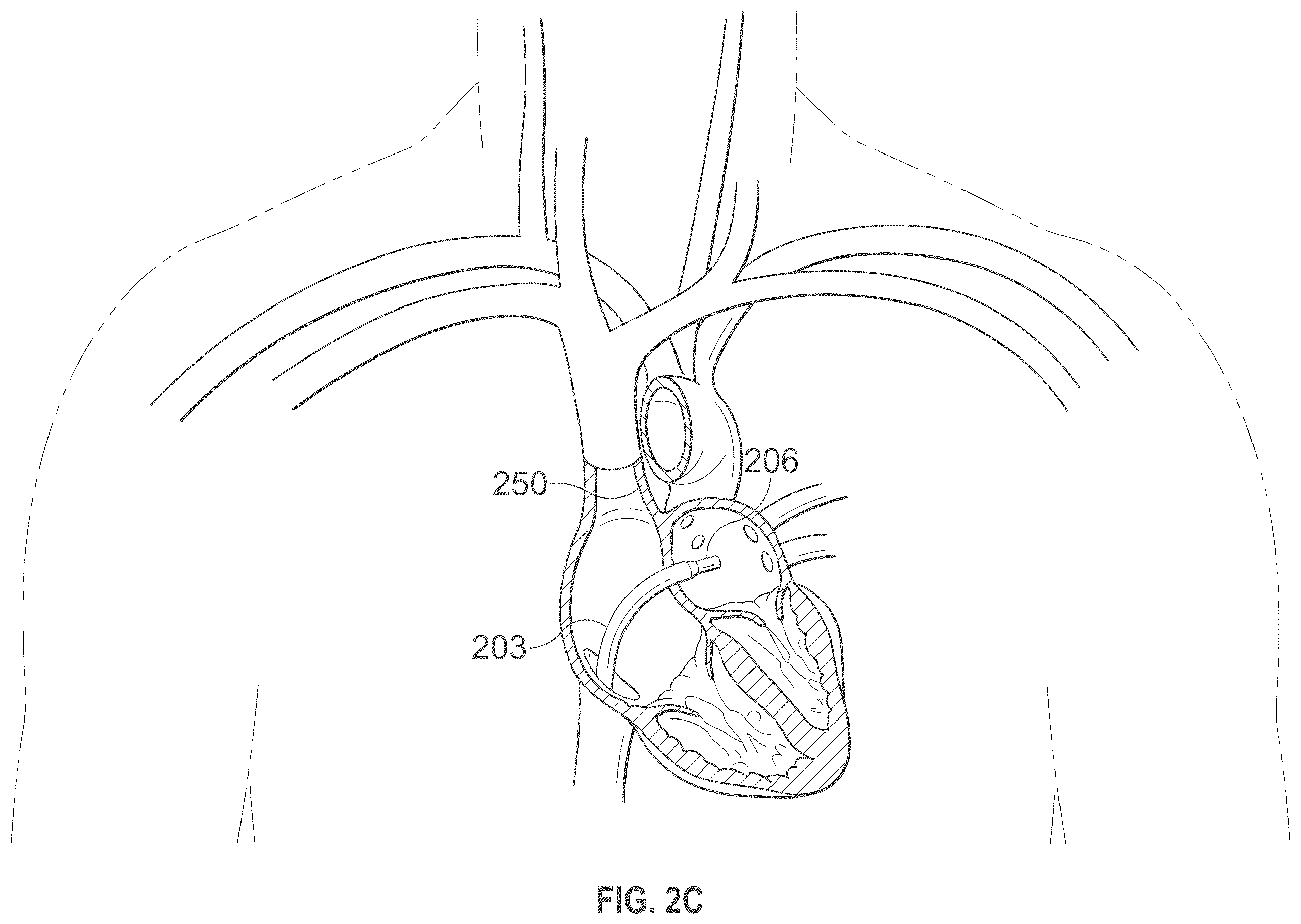 Patent US12496441 Figure 4 – Implantable endovascular, low profile intracardiac left atrial restraining devices for low energy atrial cardioversion, pacing and sensing