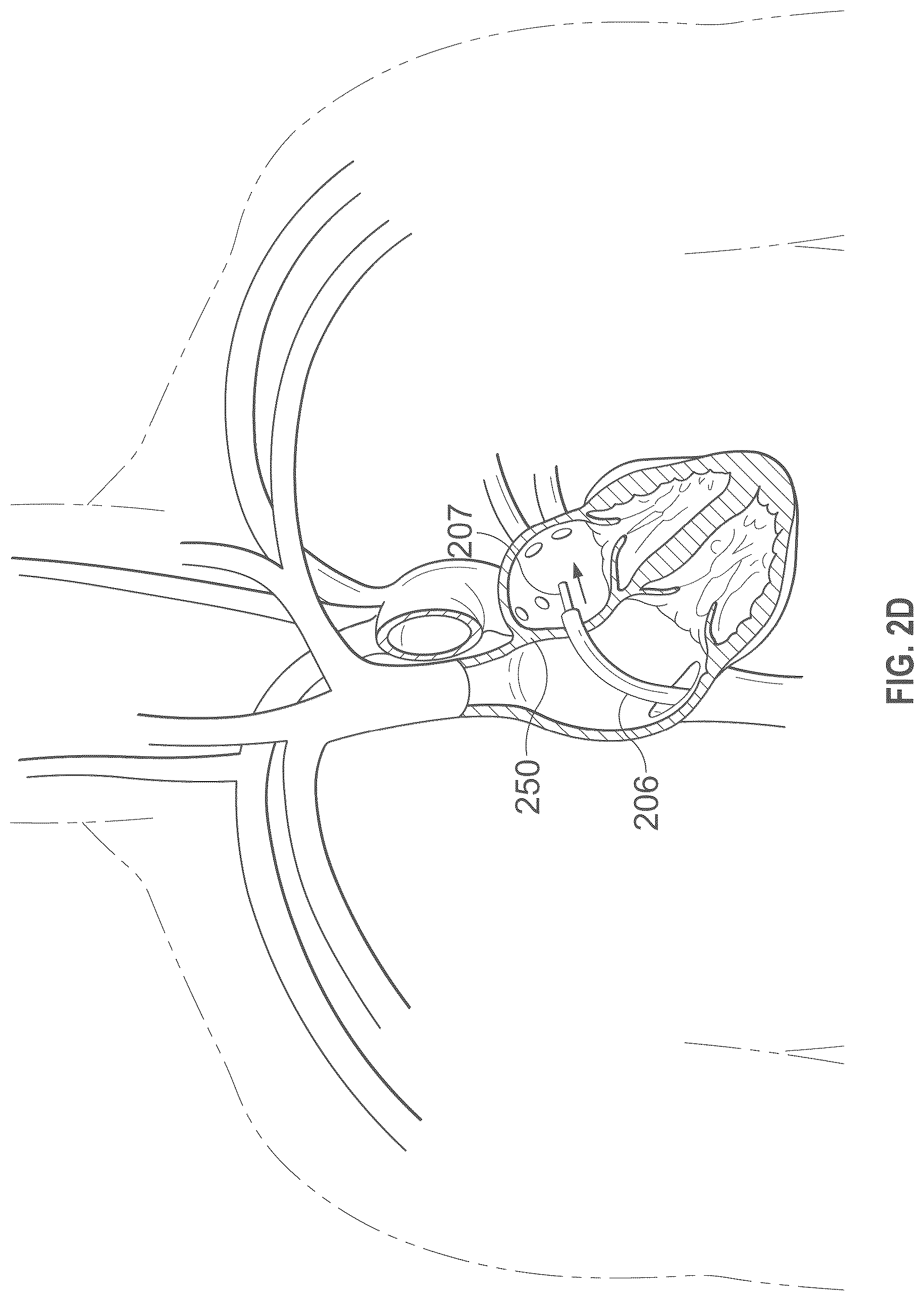 Patent US12496441 Figure 5 – Implantable endovascular, low profile intracardiac left atrial restraining devices for low energy atrial cardioversion, pacing and sensing