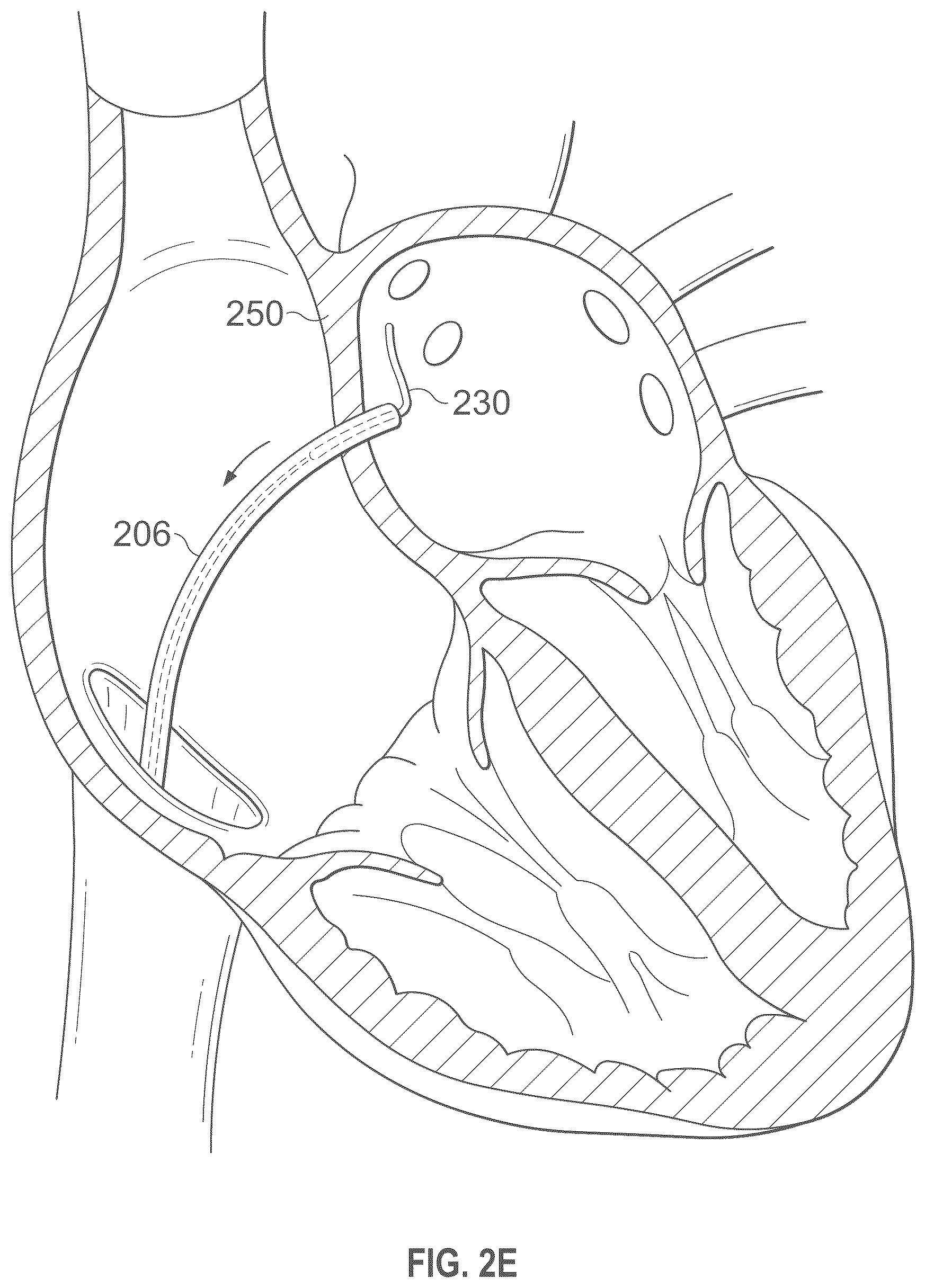 Patent US12496441 Figure 6 – Implantable endovascular, low profile intracardiac left atrial restraining devices for low energy atrial cardioversion, pacing and sensing