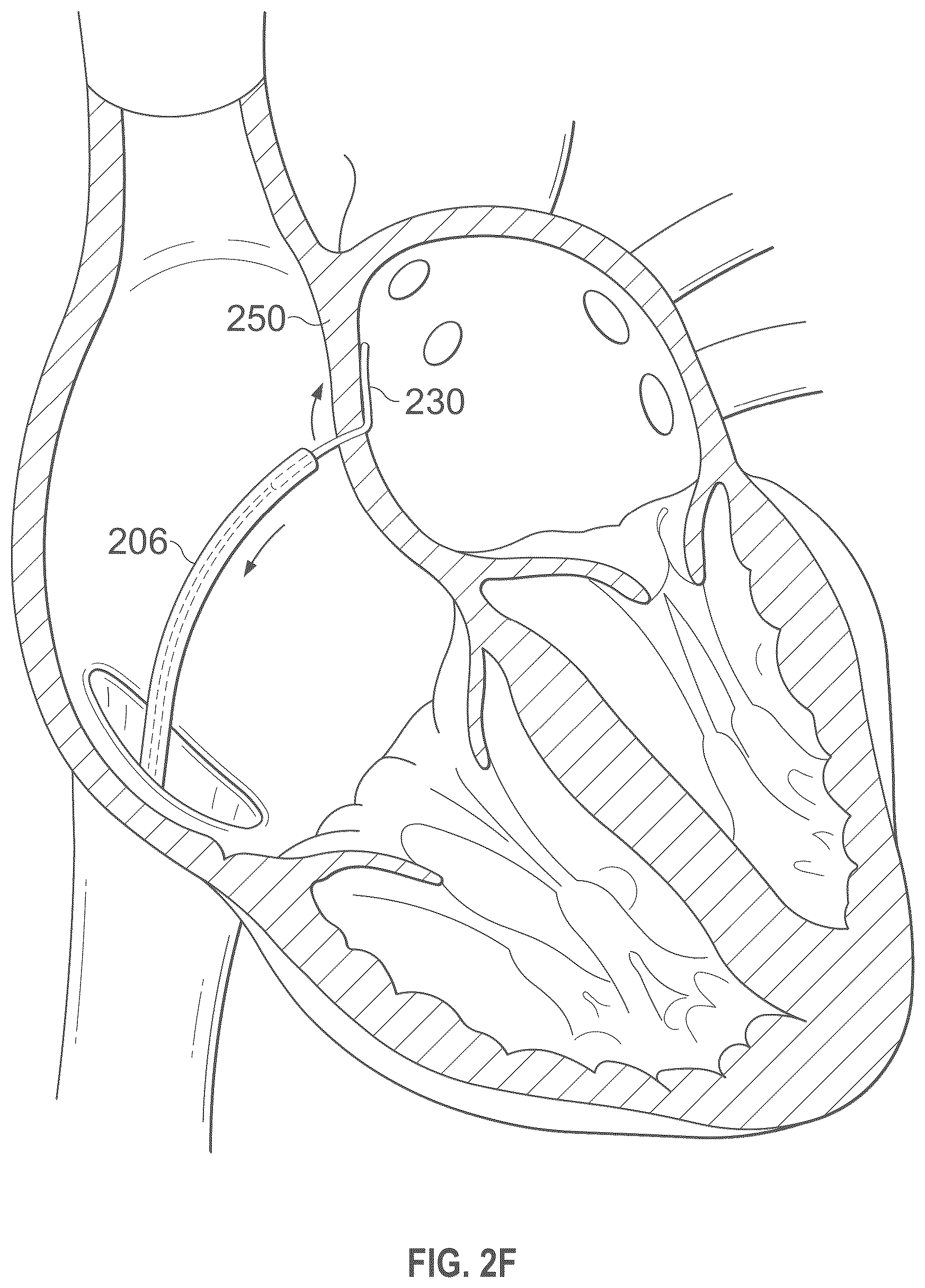 Patent US12496441 Figure 7 – Implantable endovascular, low profile intracardiac left atrial restraining devices for low energy atrial cardioversion, pacing and sensing