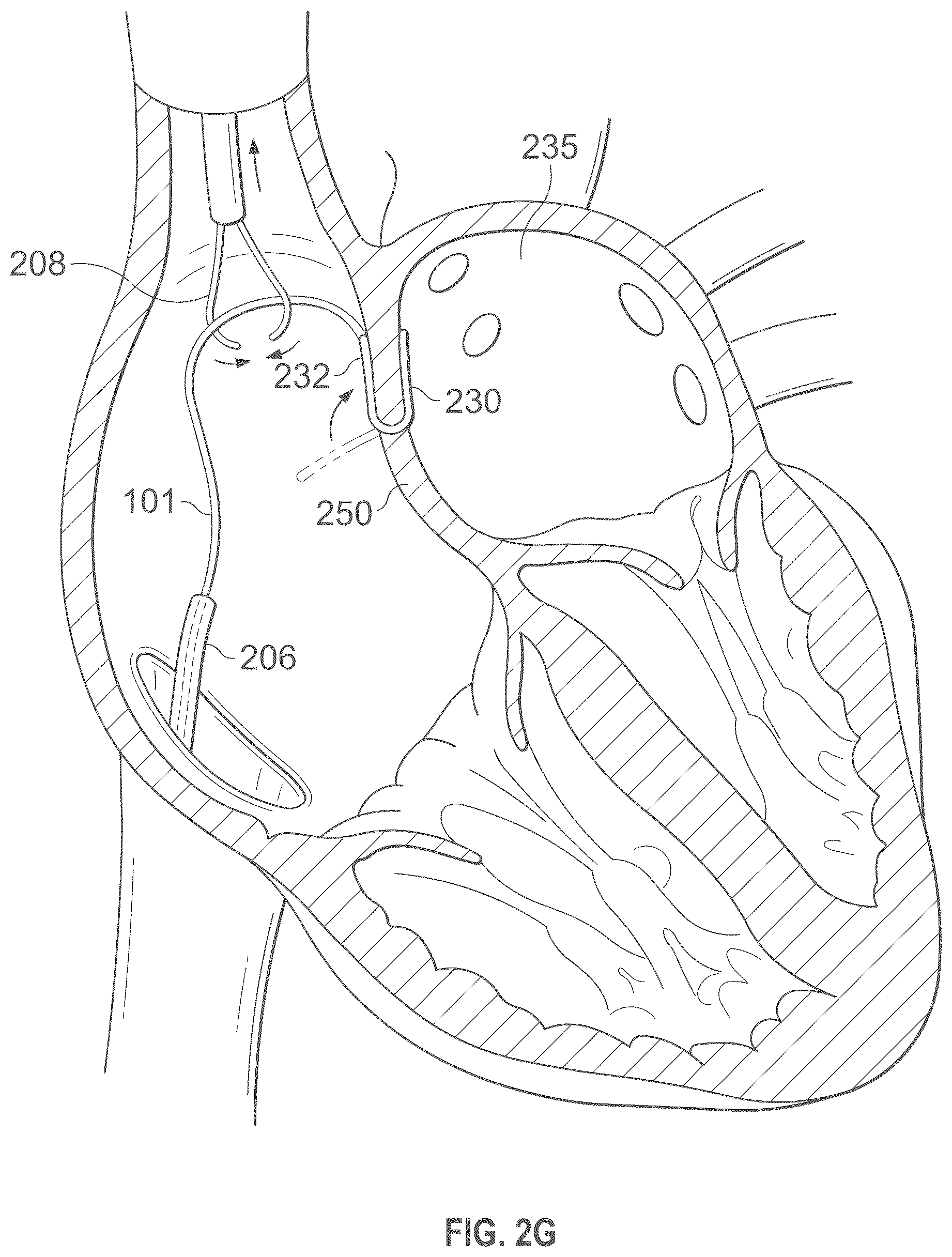 Patent US12496441 Figure 8 – Implantable endovascular, low profile intracardiac left atrial restraining devices for low energy atrial cardioversion, pacing and sensing