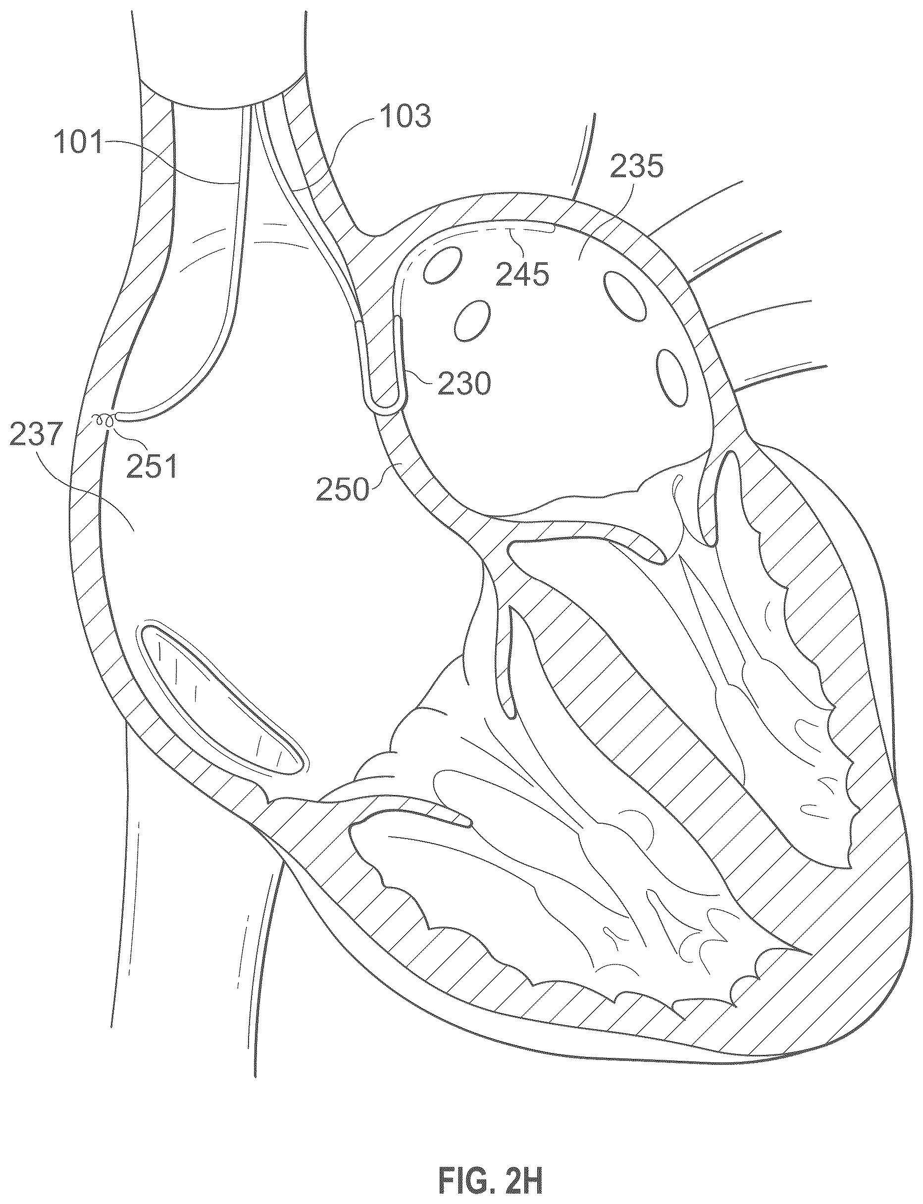 Patent US12496441 Figure 9 – Implantable endovascular, low profile intracardiac left atrial restraining devices for low energy atrial cardioversion, pacing and sensing