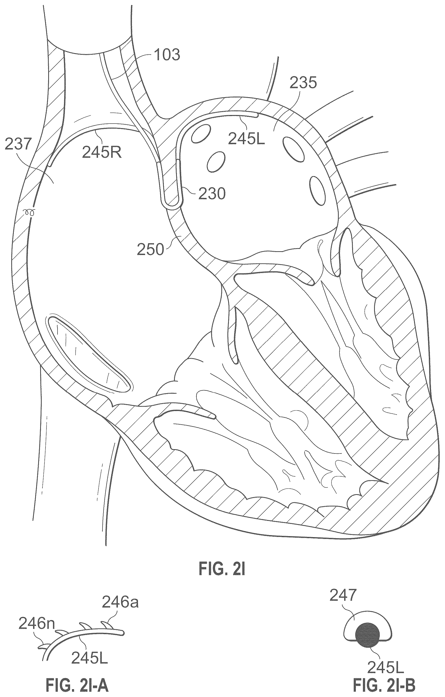 Patent US12496441 Figure 10 – Implantable endovascular, low profile intracardiac left atrial restraining devices for low energy atrial cardioversion, pacing and sensing