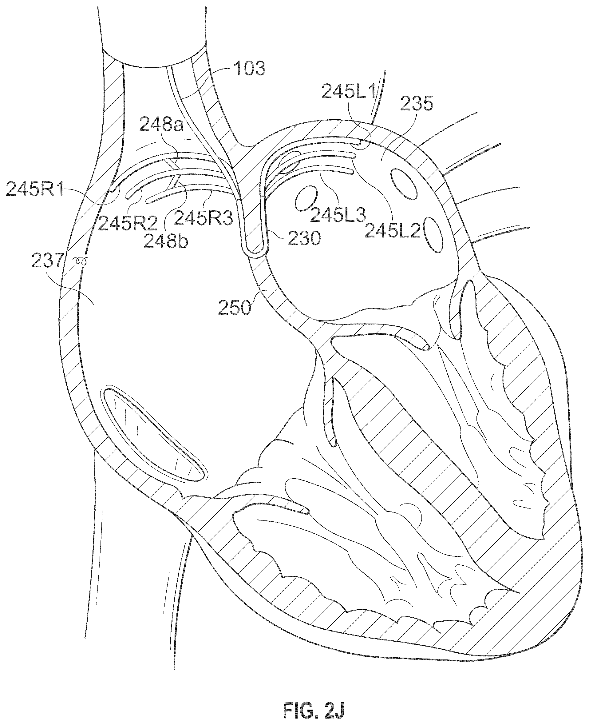 Patent US12496441 Figure 11 – Implantable endovascular, low profile intracardiac left atrial restraining devices for low energy atrial cardioversion, pacing and sensing