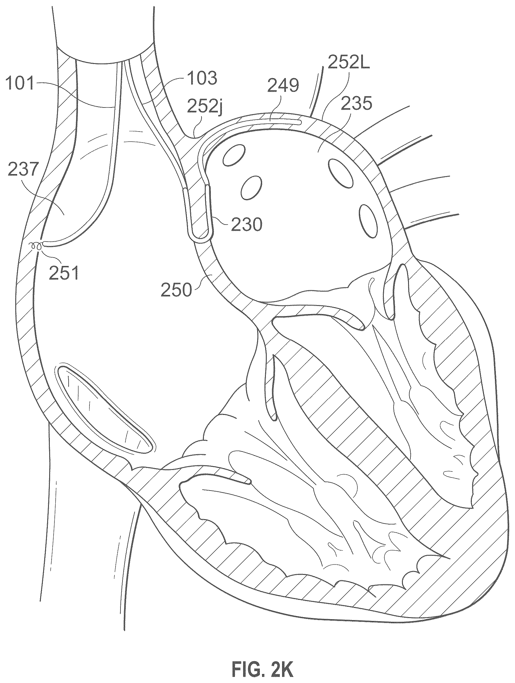 Patent US12496441 Figure 12 – Implantable endovascular, low profile intracardiac left atrial restraining devices for low energy atrial cardioversion, pacing and sensing