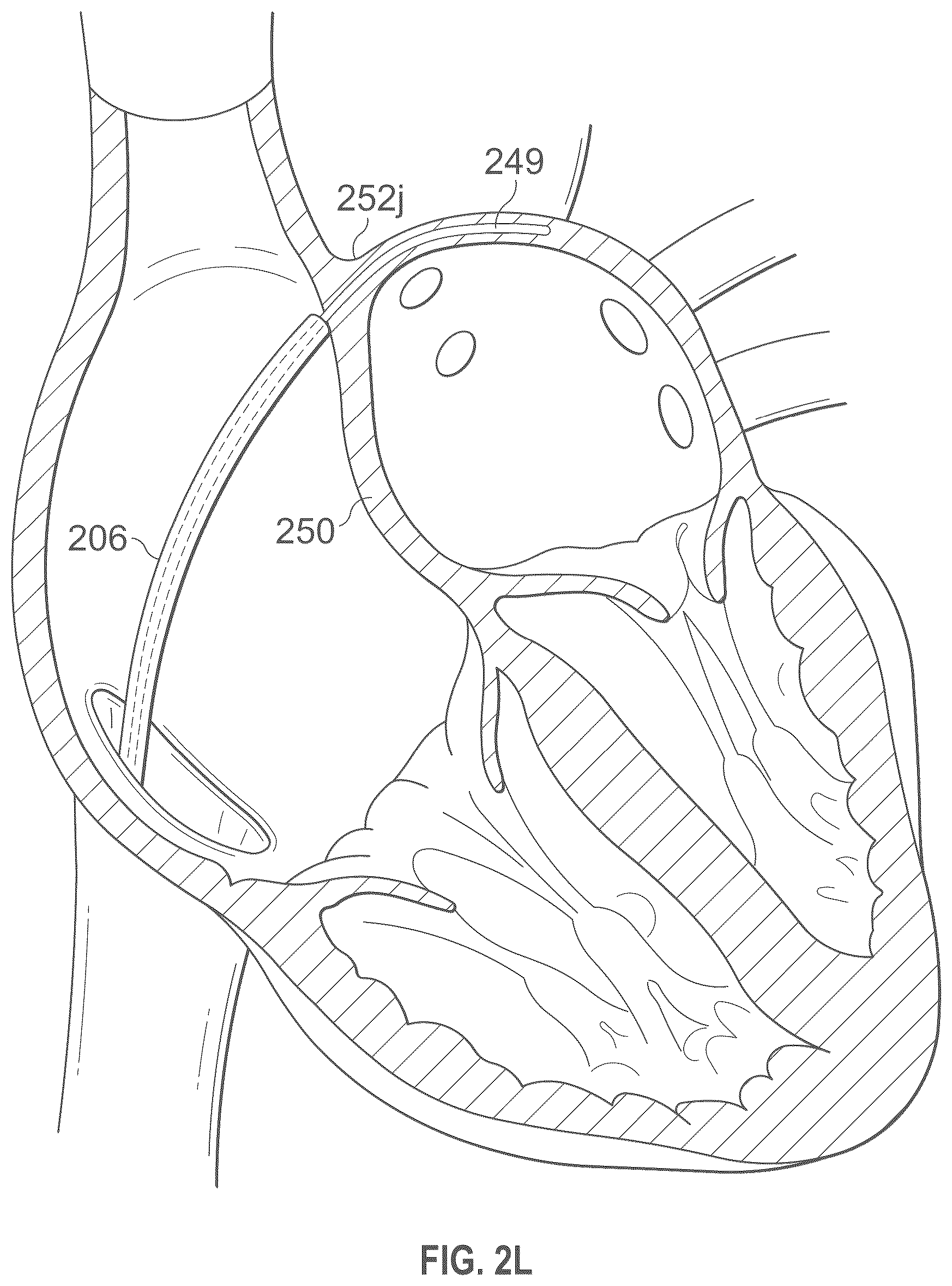 Patent US12496441 Figure 13 – Implantable endovascular, low profile intracardiac left atrial restraining devices for low energy atrial cardioversion, pacing and sensing
