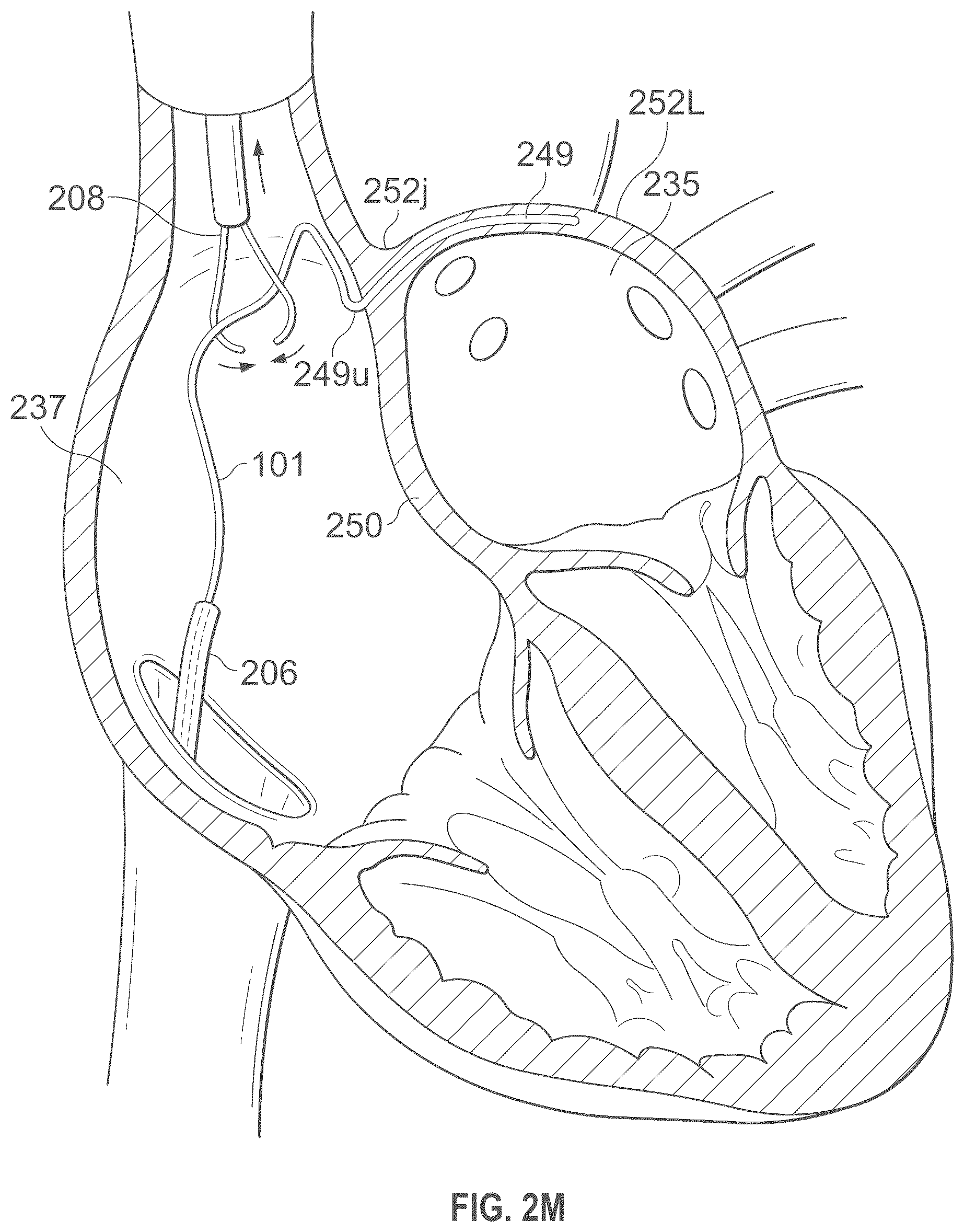 Patent US12496441 Figure 14 – Implantable endovascular, low profile intracardiac left atrial restraining devices for low energy atrial cardioversion, pacing and sensing