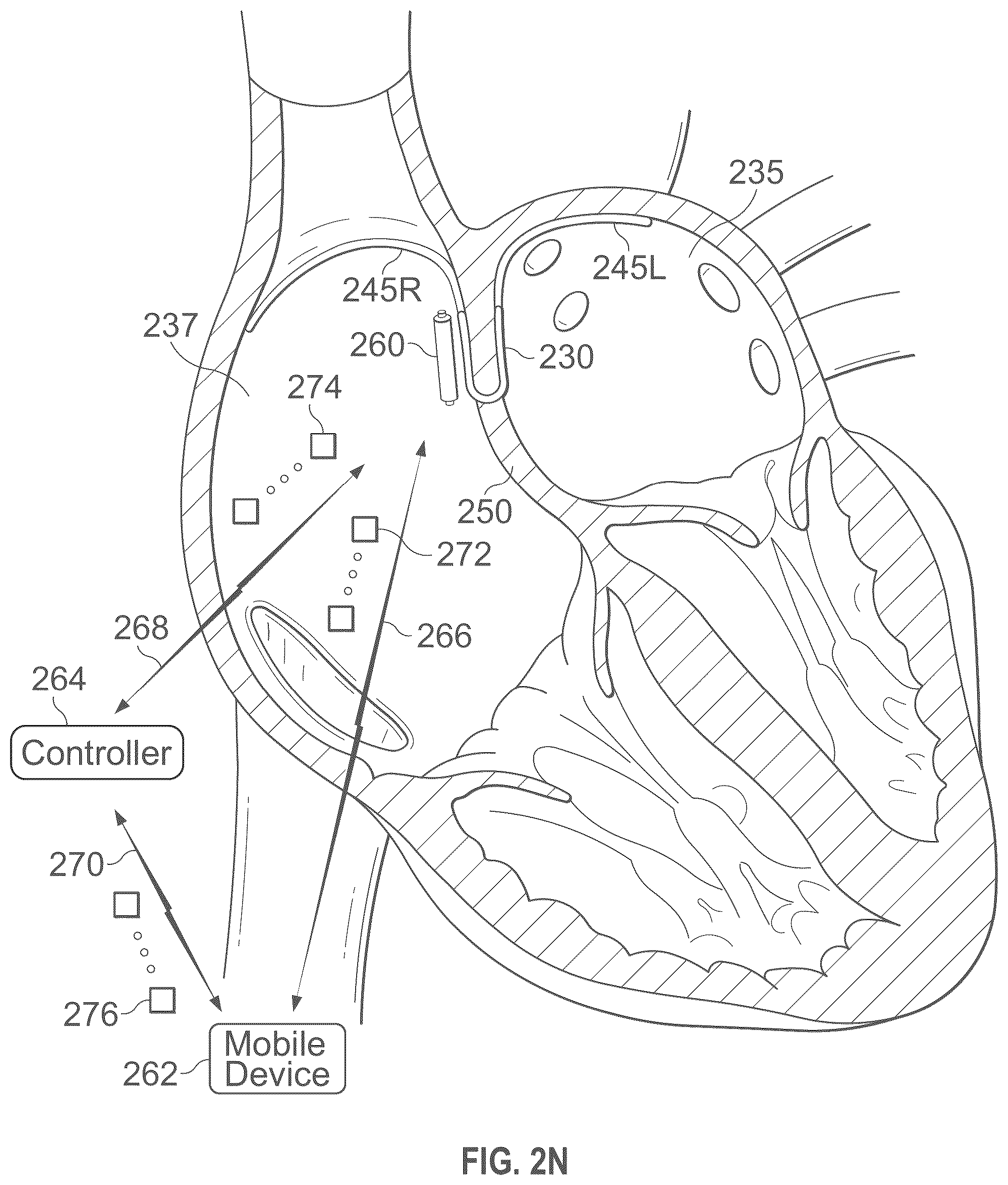 Patent US12496441 Figure 15 – Implantable endovascular, low profile intracardiac left atrial restraining devices for low energy atrial cardioversion, pacing and sensing