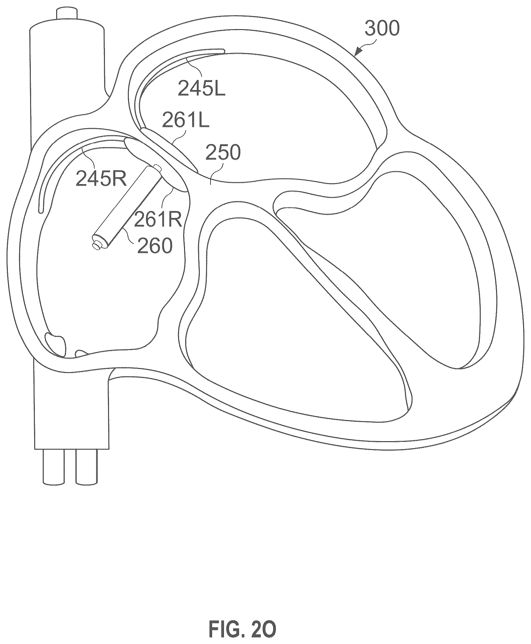 Patent US12496441 Figure 16 – Implantable endovascular, low profile intracardiac left atrial restraining devices for low energy atrial cardioversion, pacing and sensing
