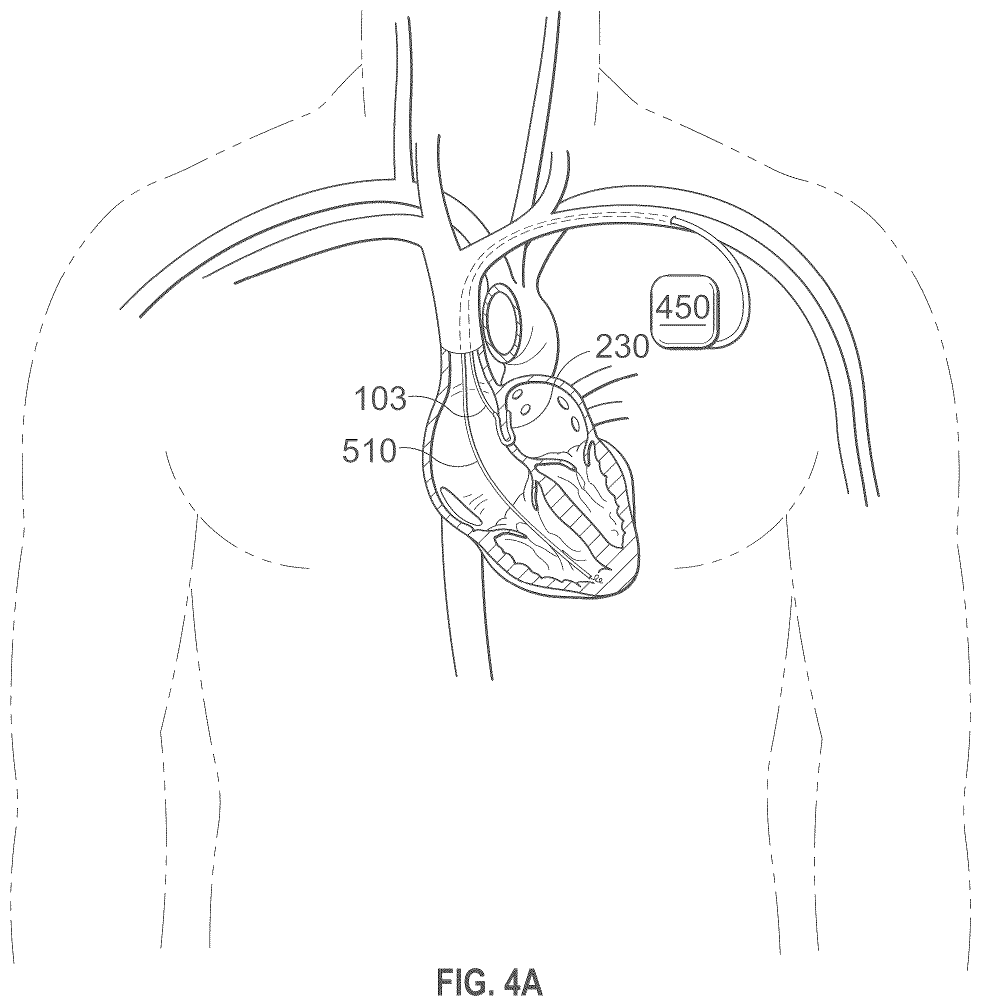 Patent US12496441 Figure 18 – Implantable endovascular, low profile intracardiac left atrial restraining devices for low energy atrial cardioversion, pacing and sensing