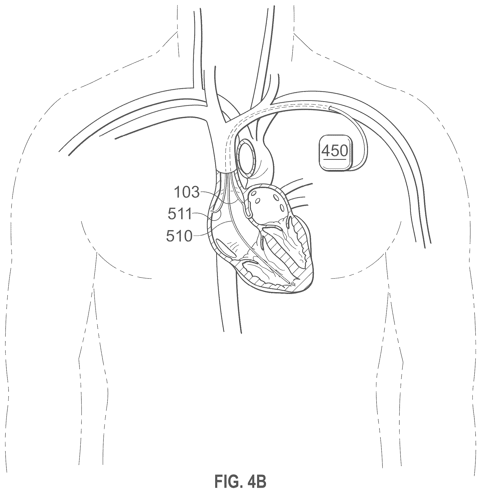 Patent US12496441 Figure 19 – Implantable endovascular, low profile intracardiac left atrial restraining devices for low energy atrial cardioversion, pacing and sensing