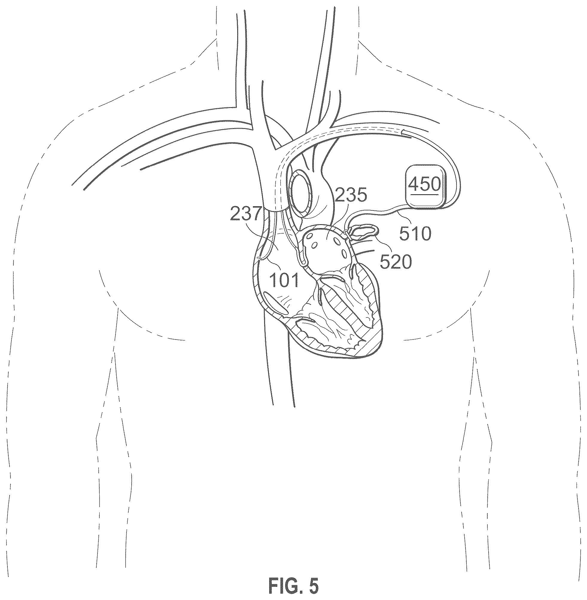 Patent US12496441 Figure 20 – Implantable endovascular, low profile intracardiac left atrial restraining devices for low energy atrial cardioversion, pacing and sensing