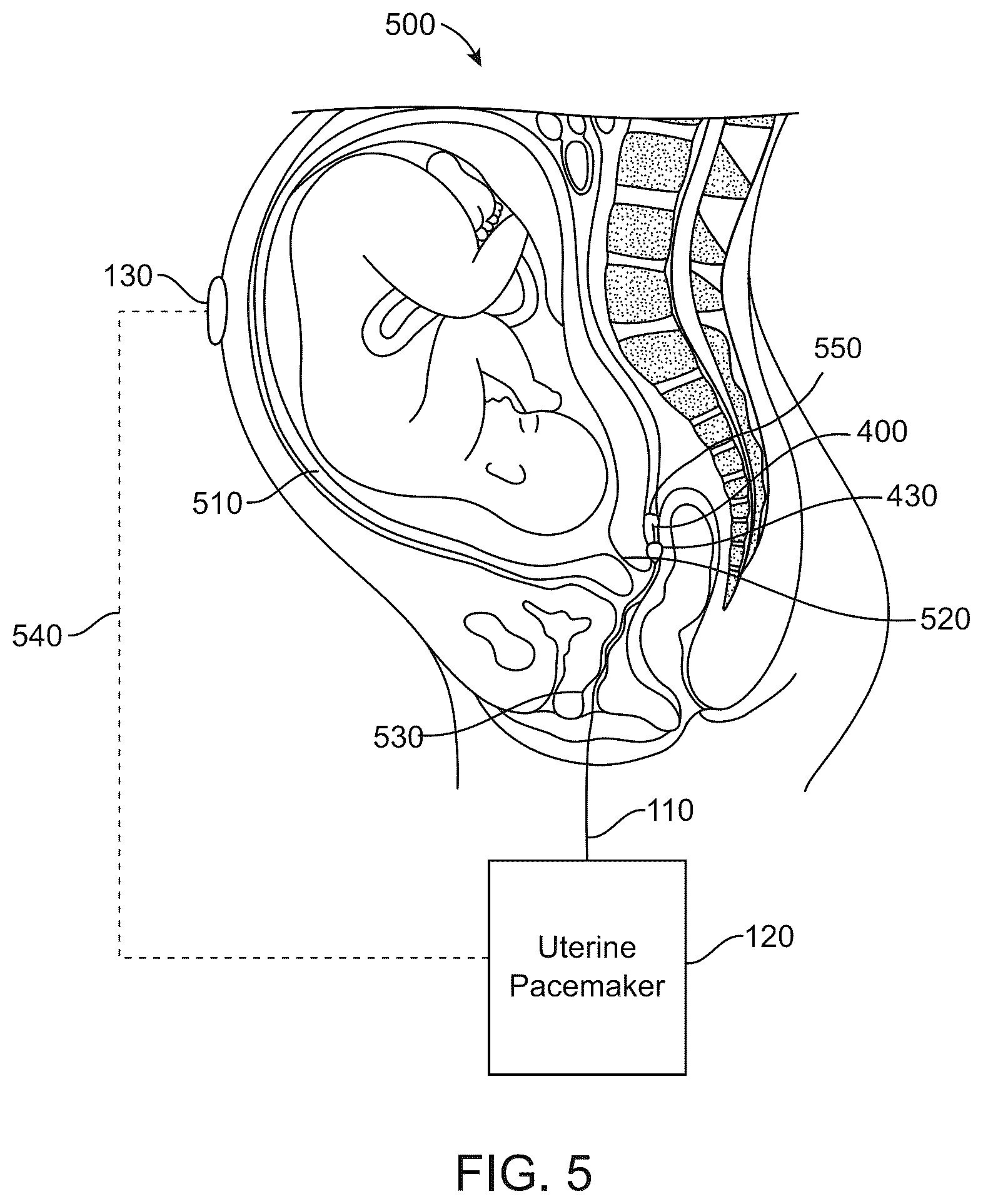 Patent US12496444 Figure 5 – Electrical muscle controller system for uterine contraction monitoring and modulation