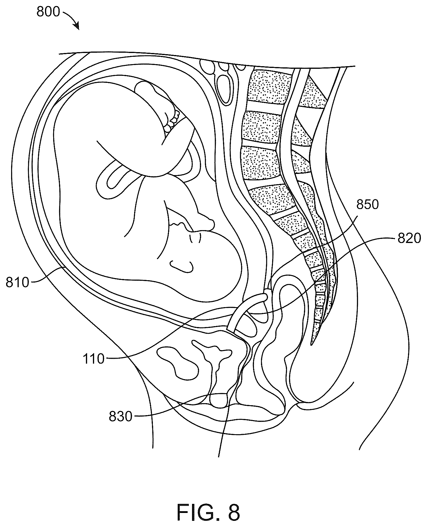 Patent US12496444 Figure 9 – Electrical muscle controller system for uterine contraction monitoring and modulation