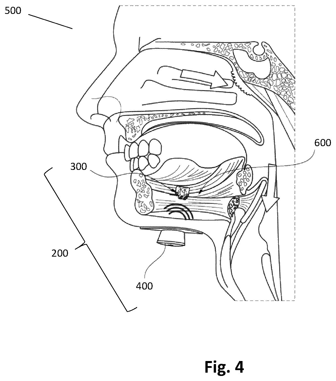 Patent US12496448 Figure 4 – Method and system for electrical nerve stimulation