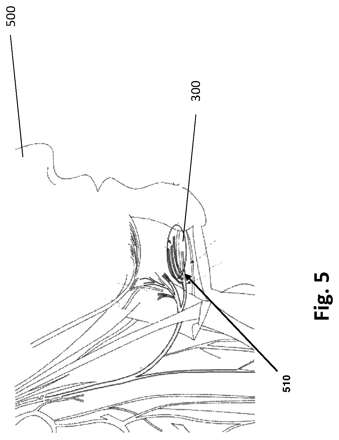 Patent US12496448 Figure 5 – Method and system for electrical nerve stimulation