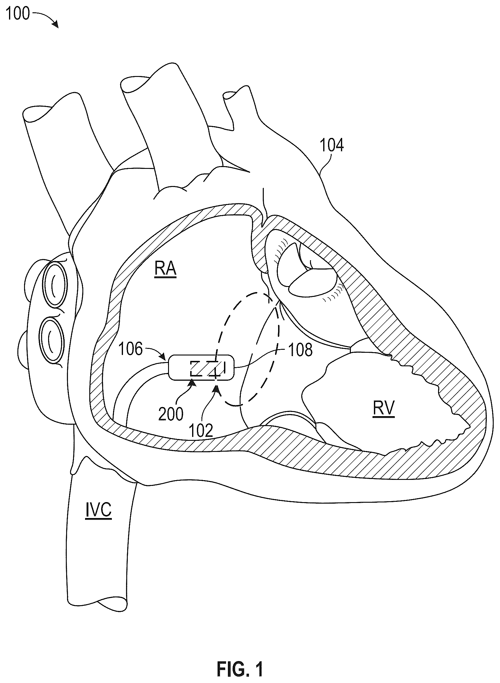 Patent US12496452 — Multi-electrode implantable medical device (IMD) — Figure 1