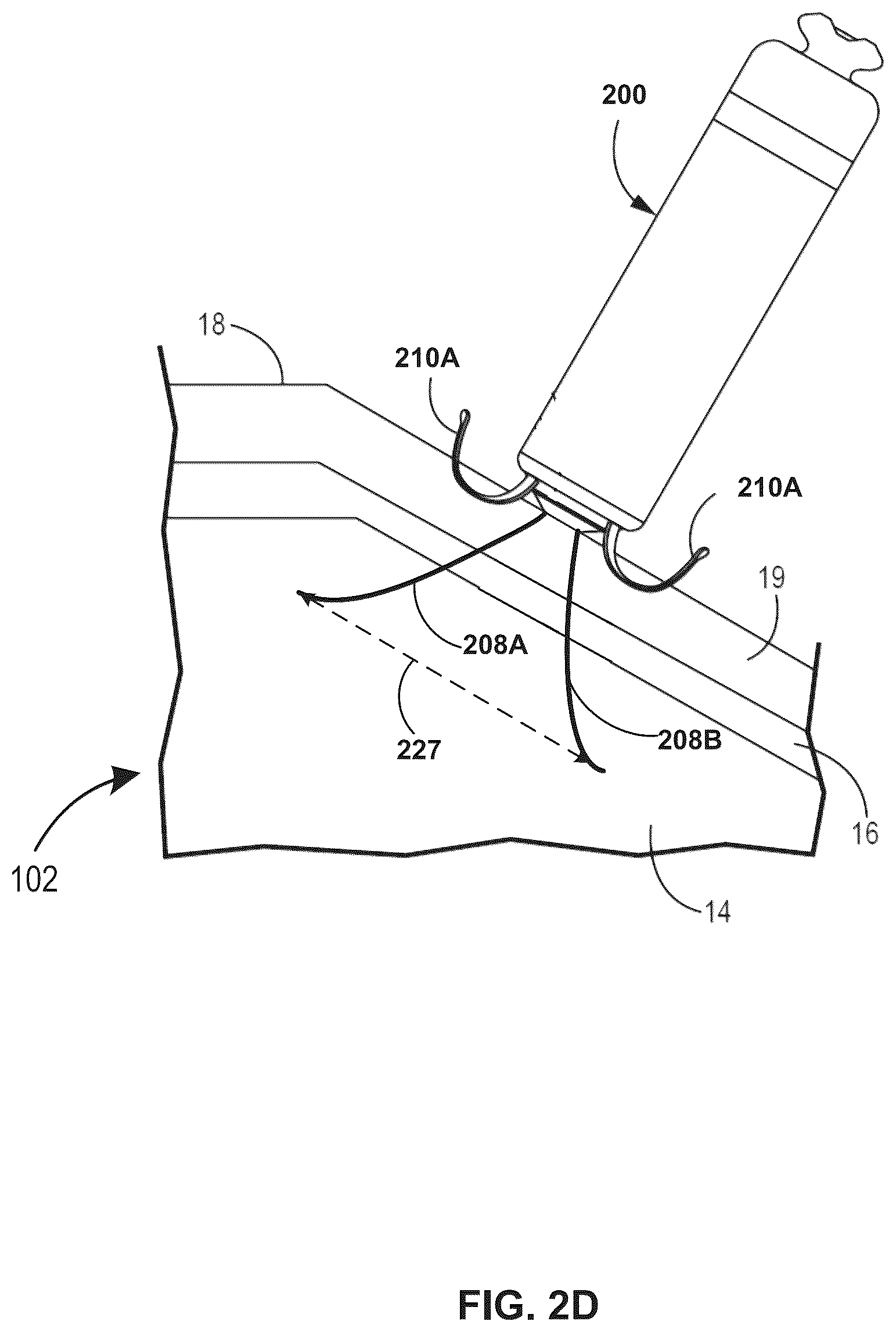 Patent US12496452 Figure 5 – Multi-electrode implantable medical device (IMD)