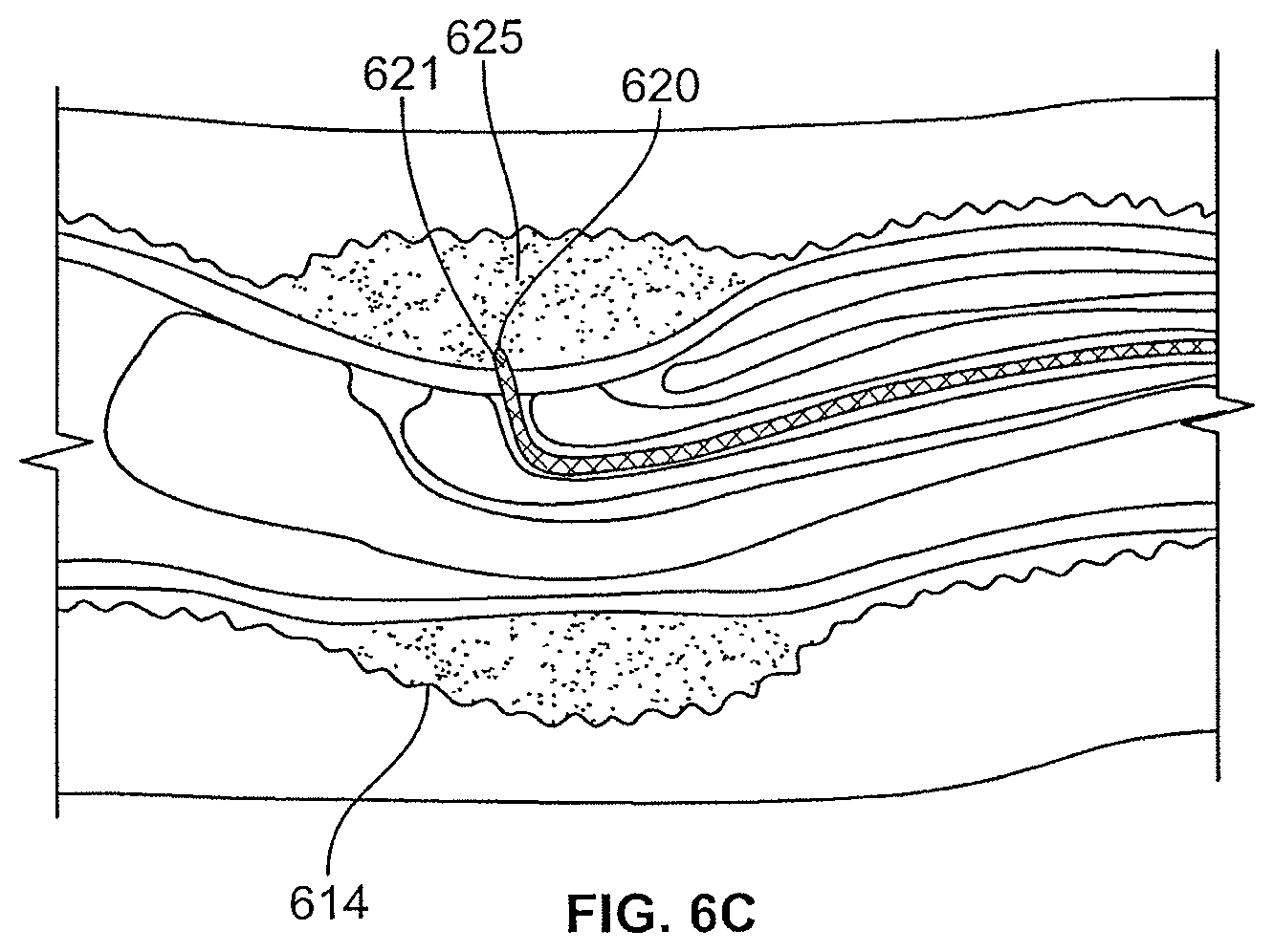 Patent US12496469 Figure 10 – Devices and methods for endoluminal delivery of either fluid or energy for denervation