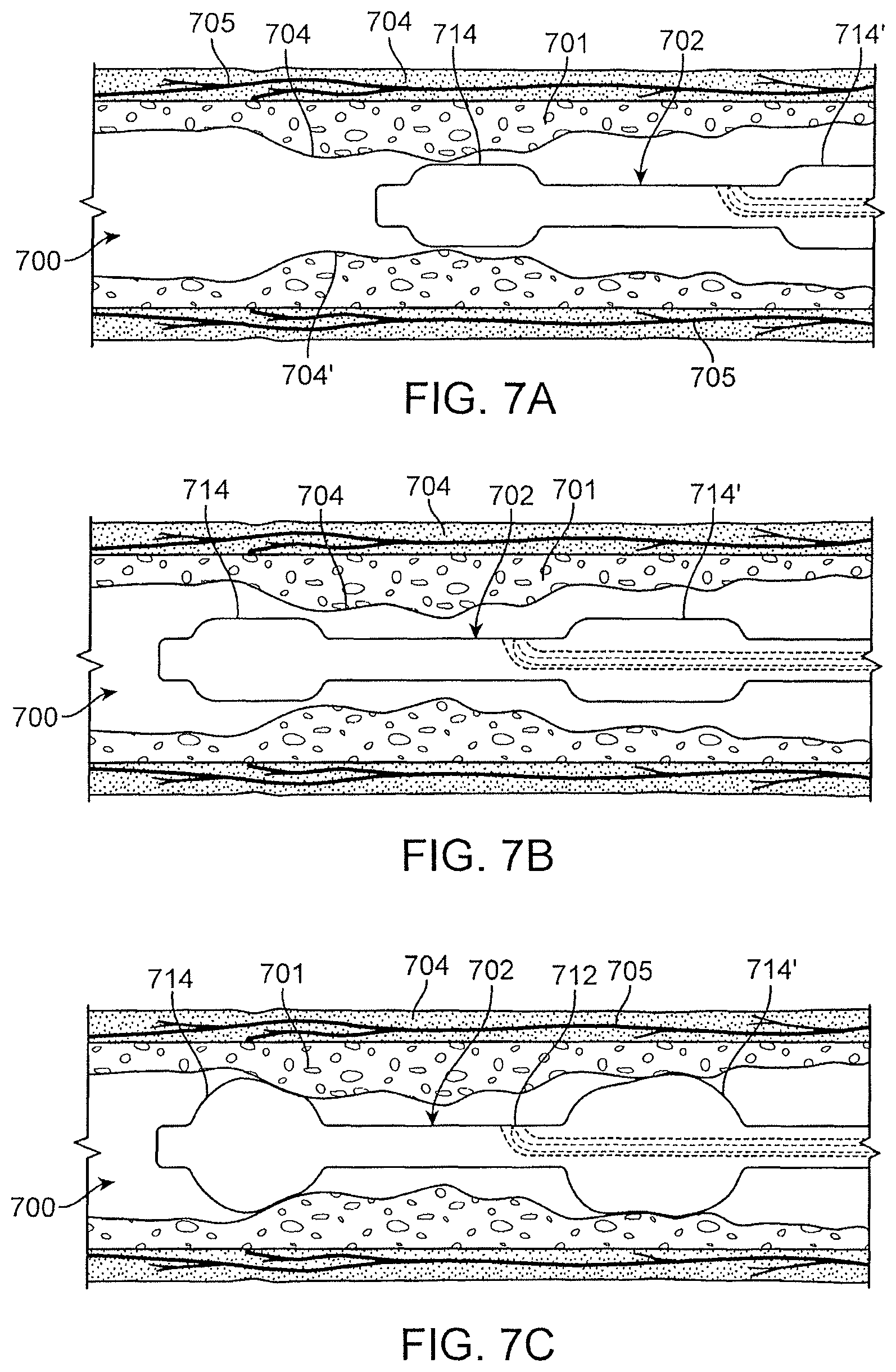 Patent US12496469 Figure 11 – Devices and methods for endoluminal delivery of either fluid or energy for denervation
