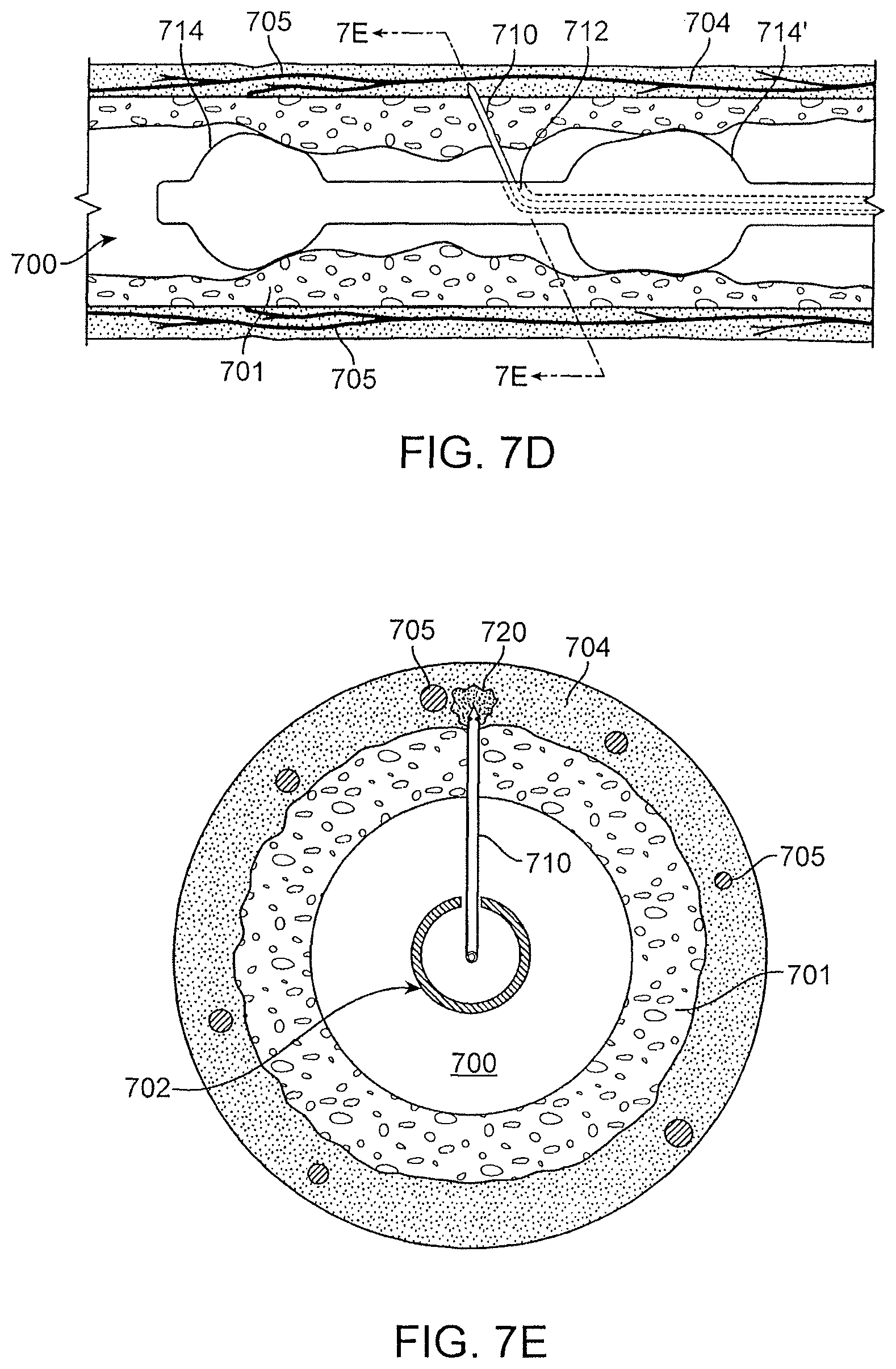 Patent US12496469 Figure 12 – Devices and methods for endoluminal delivery of either fluid or energy for denervation