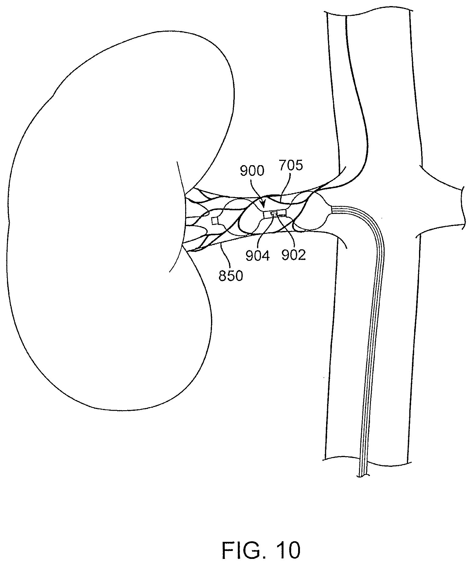 Patent US12496469 Figure 14 – Devices and methods for endoluminal delivery of either fluid or energy for denervation
