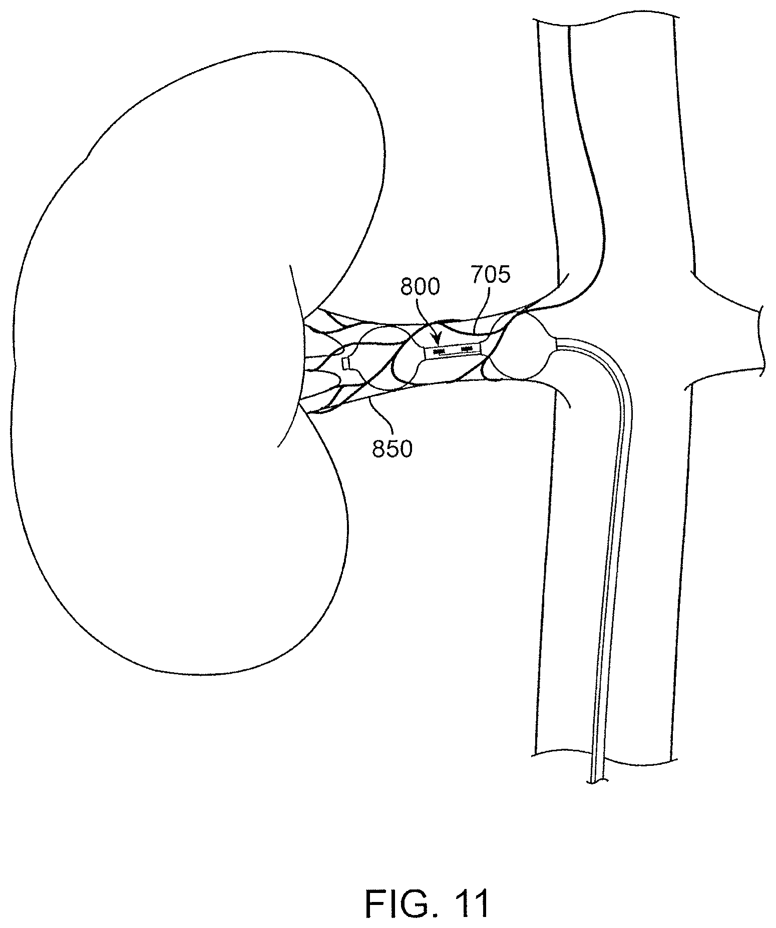 Patent US12496469 Figure 15 – Devices and methods for endoluminal delivery of either fluid or energy for denervation