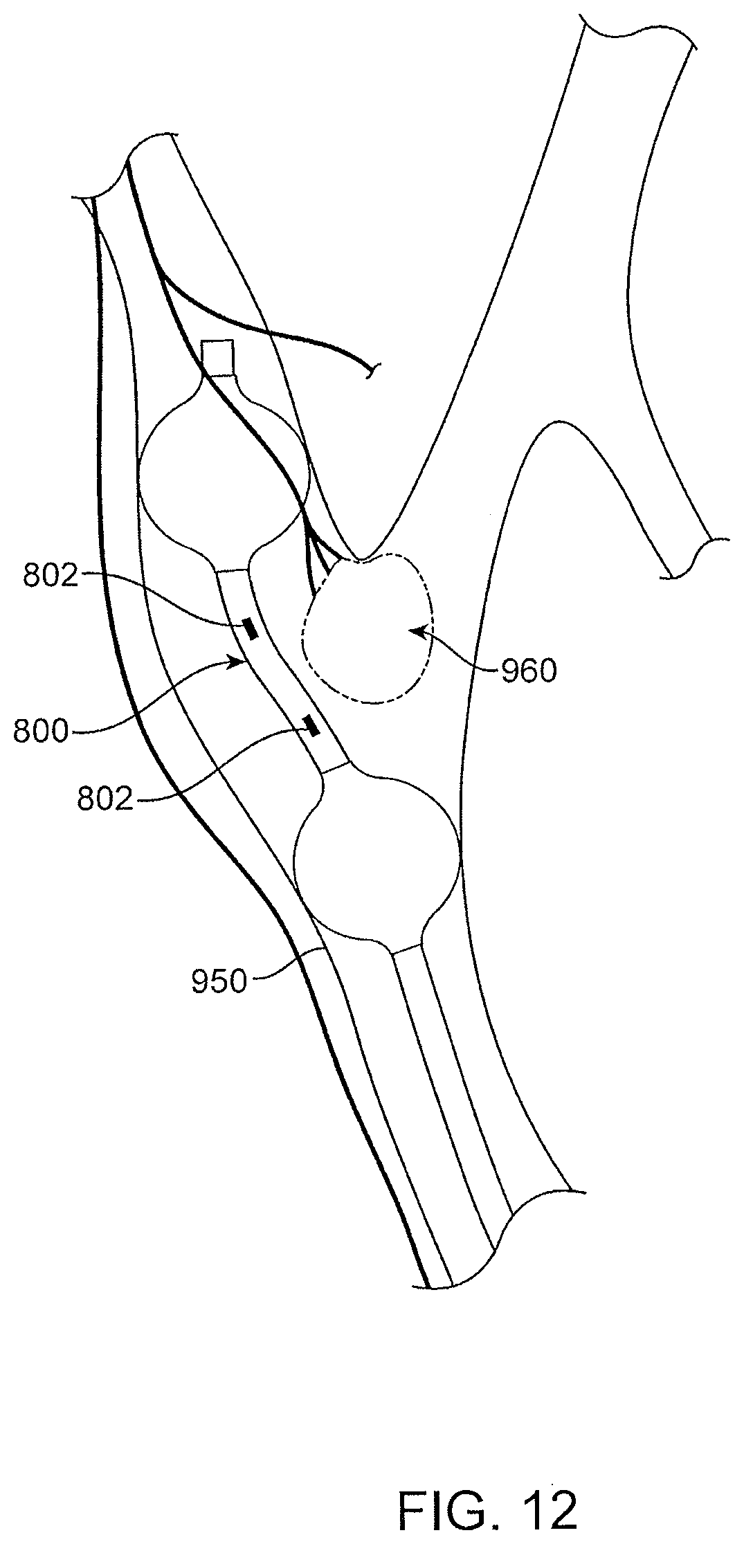 Patent US12496469 Figure 16 – Devices and methods for endoluminal delivery of either fluid or energy for denervation