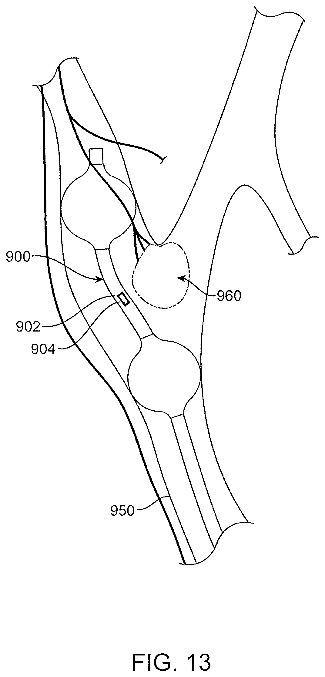 Patent US12496469 Figure 17 – Devices and methods for endoluminal delivery of either fluid or energy for denervation