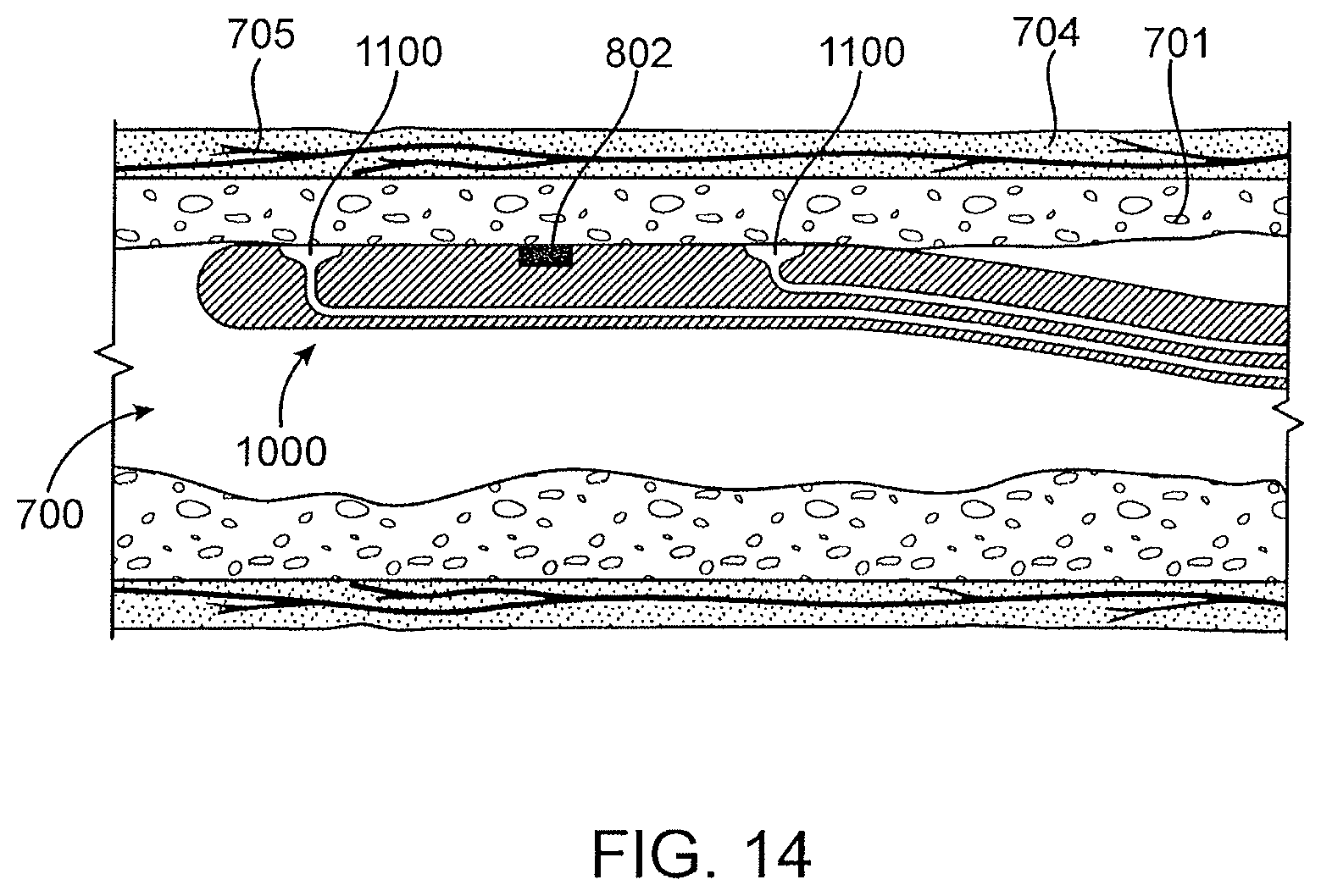Patent US12496469 Figure 18 – Devices and methods for endoluminal delivery of either fluid or energy for denervation