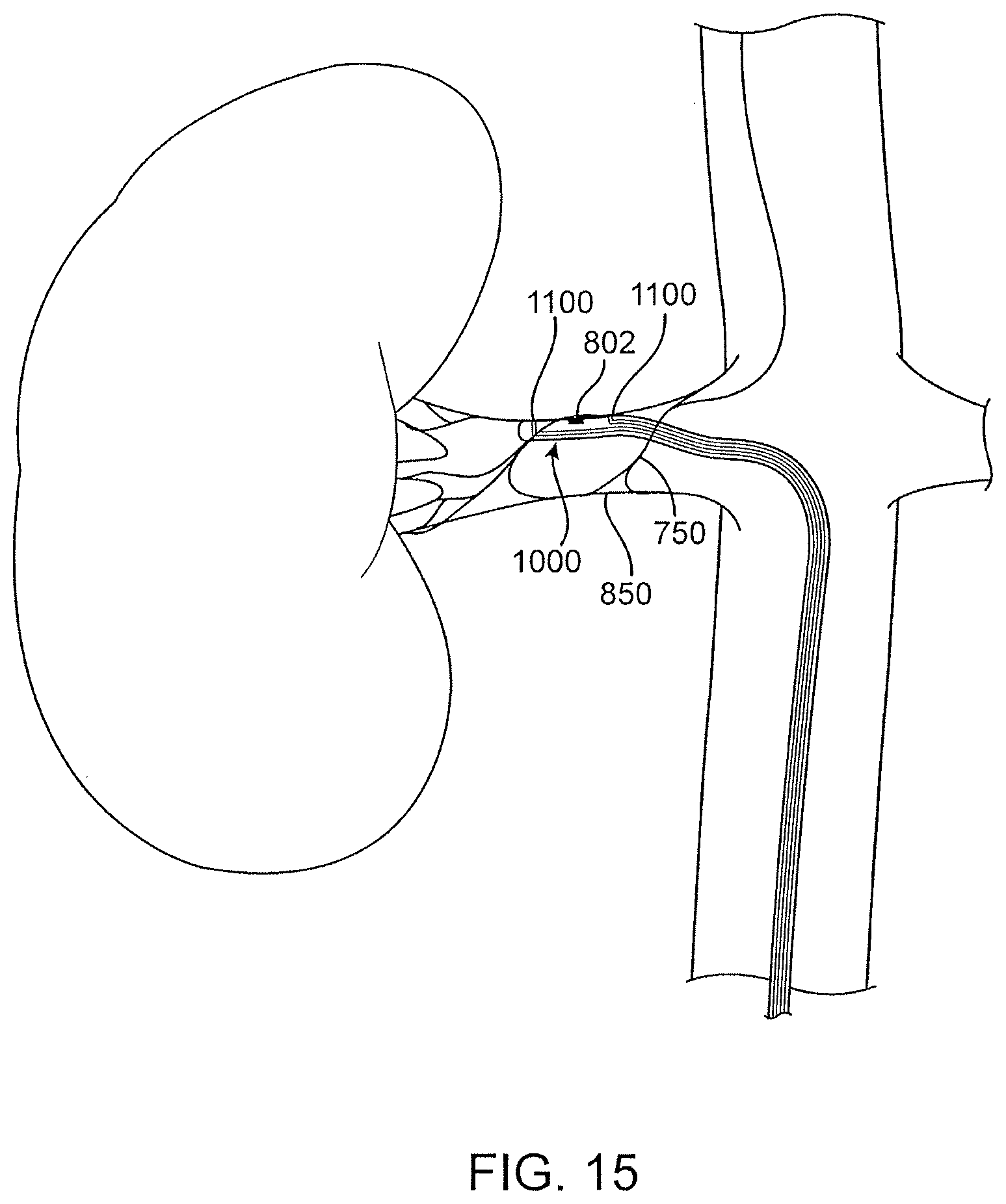 Patent US12496469 Figure 19 – Devices and methods for endoluminal delivery of either fluid or energy for denervation