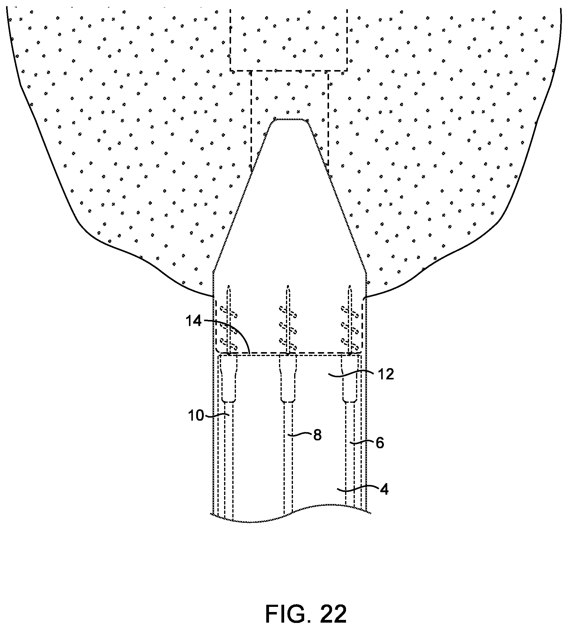 Patent US12508007 Figure 20 – Methods and devices for manipulating and fastening tissue