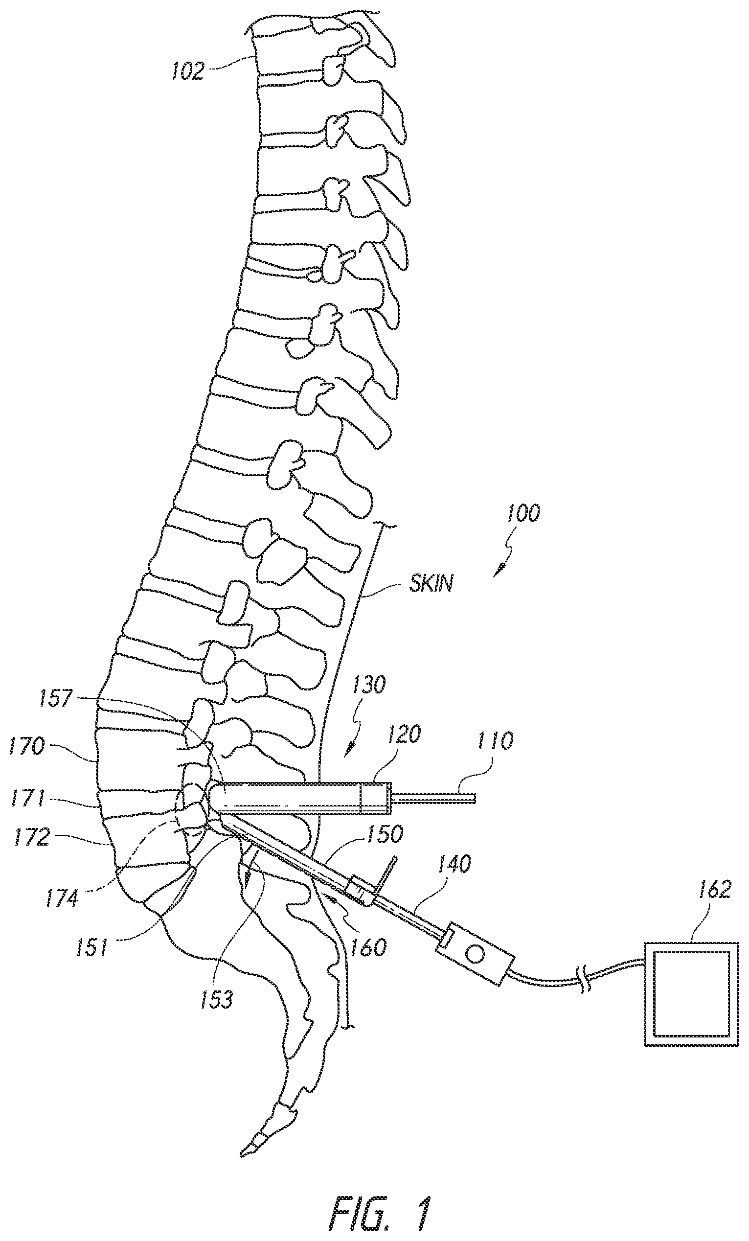 Patent US12508009 Figure 1 – Multi-portal split cannulas, endoscopic hemostatic dispensers and surgical tools