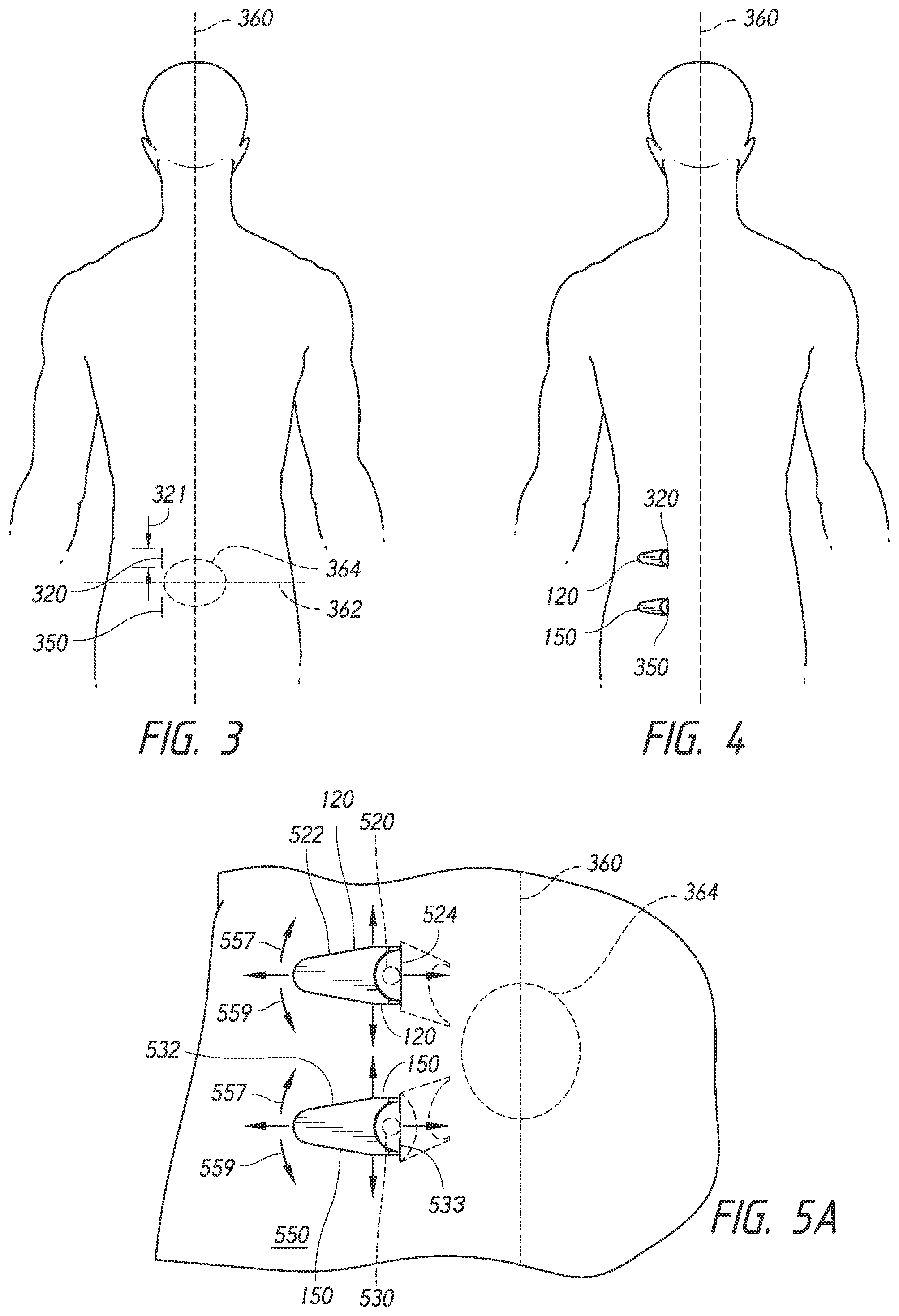 Patent US12508009 Figure 3 – Multi-portal split cannulas, endoscopic hemostatic dispensers and surgical tools