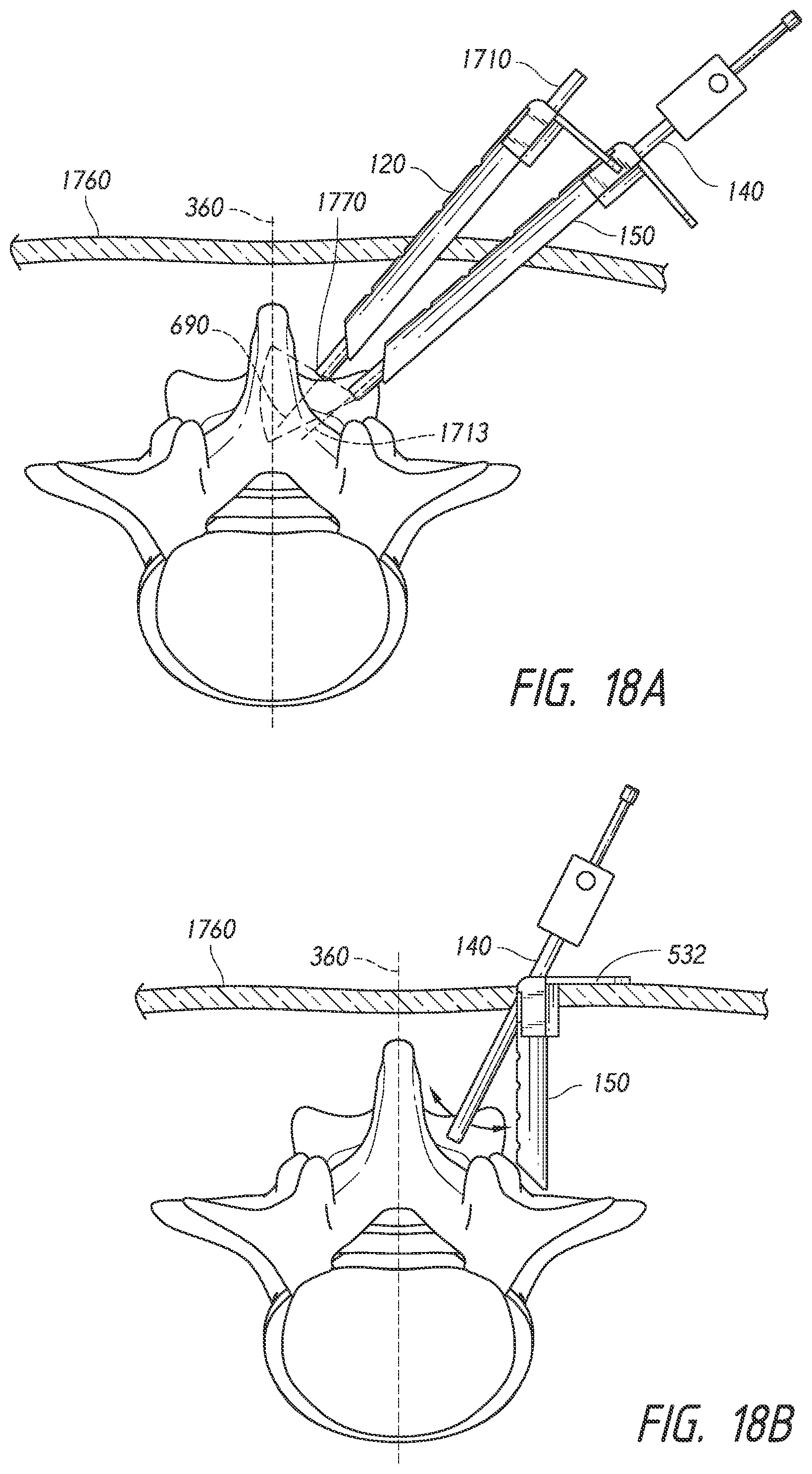 Patent US12508009 Figure 11 – Multi-portal split cannulas, endoscopic hemostatic dispensers and surgical tools