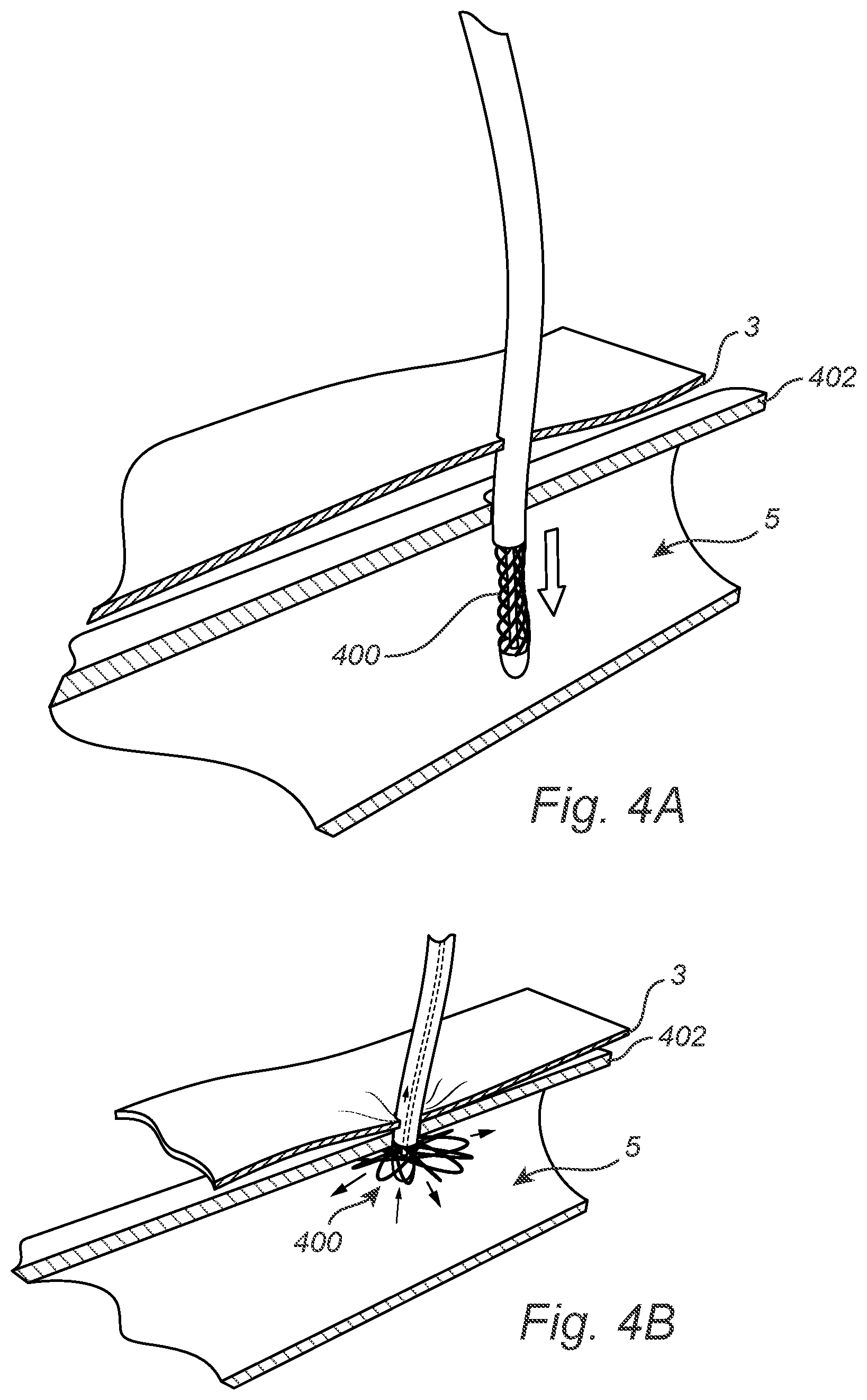 Patent US12508011 Figure 4 – Vascular closure device