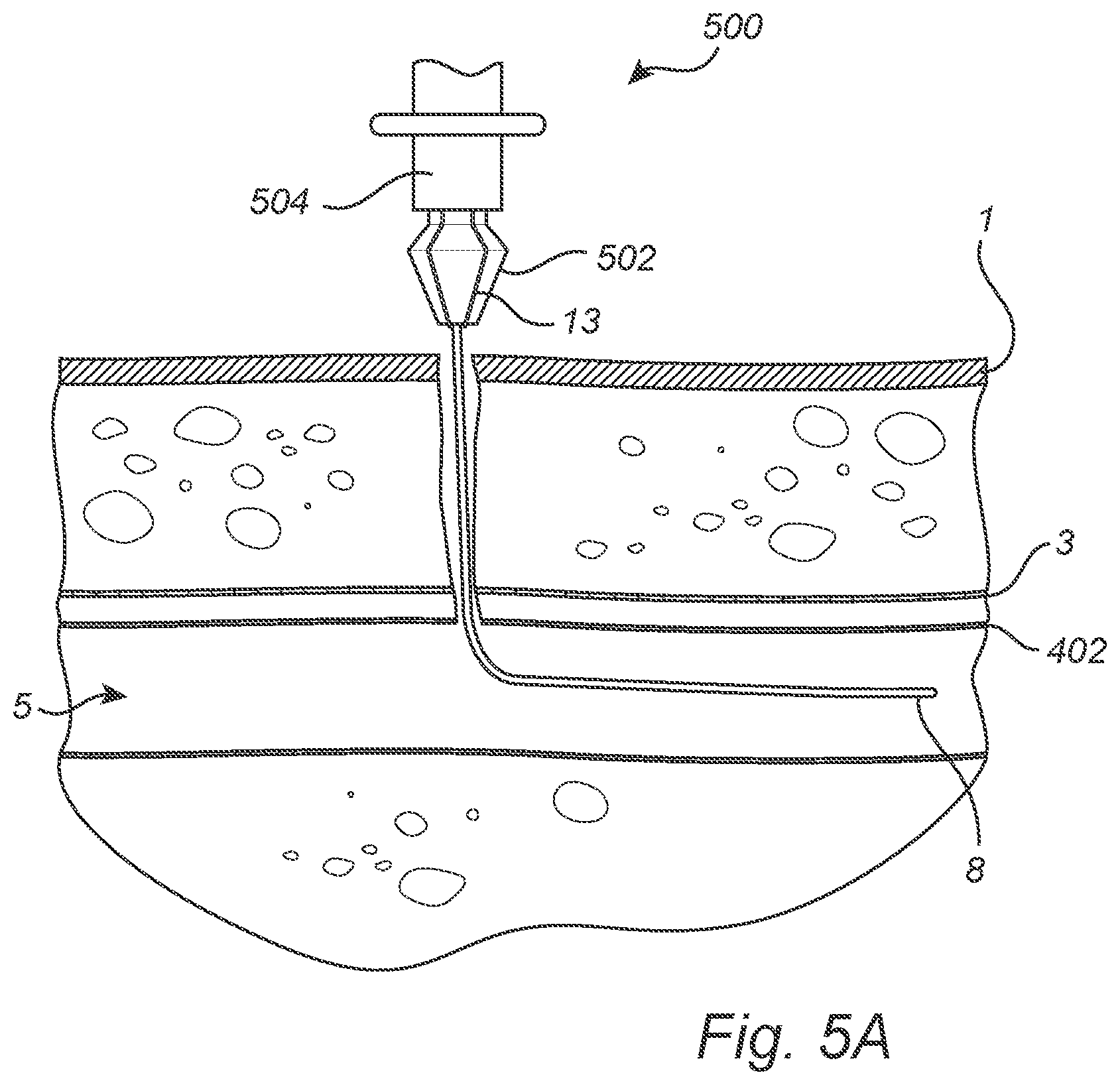 Patent US12508011 Figure 5 – Vascular closure device