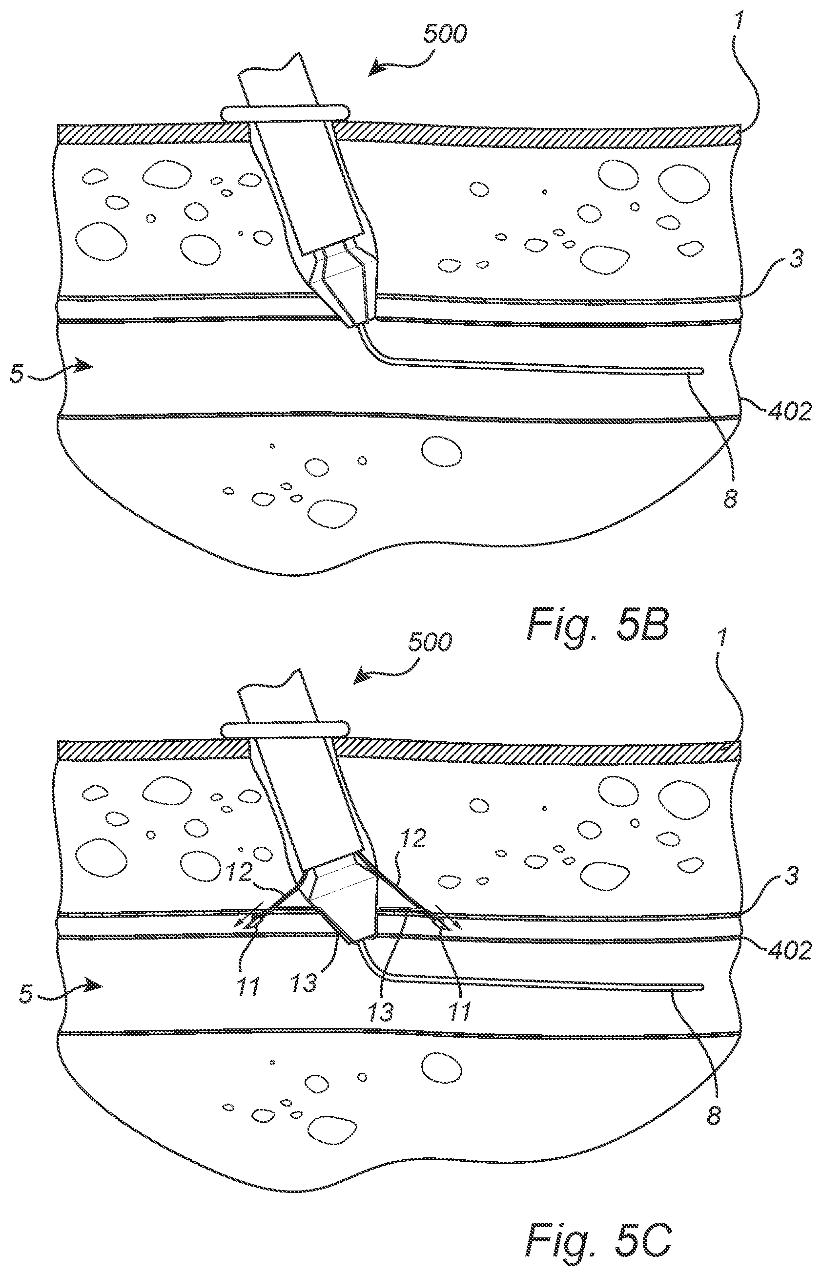 Patent US12508011 Figure 6 – Vascular closure device