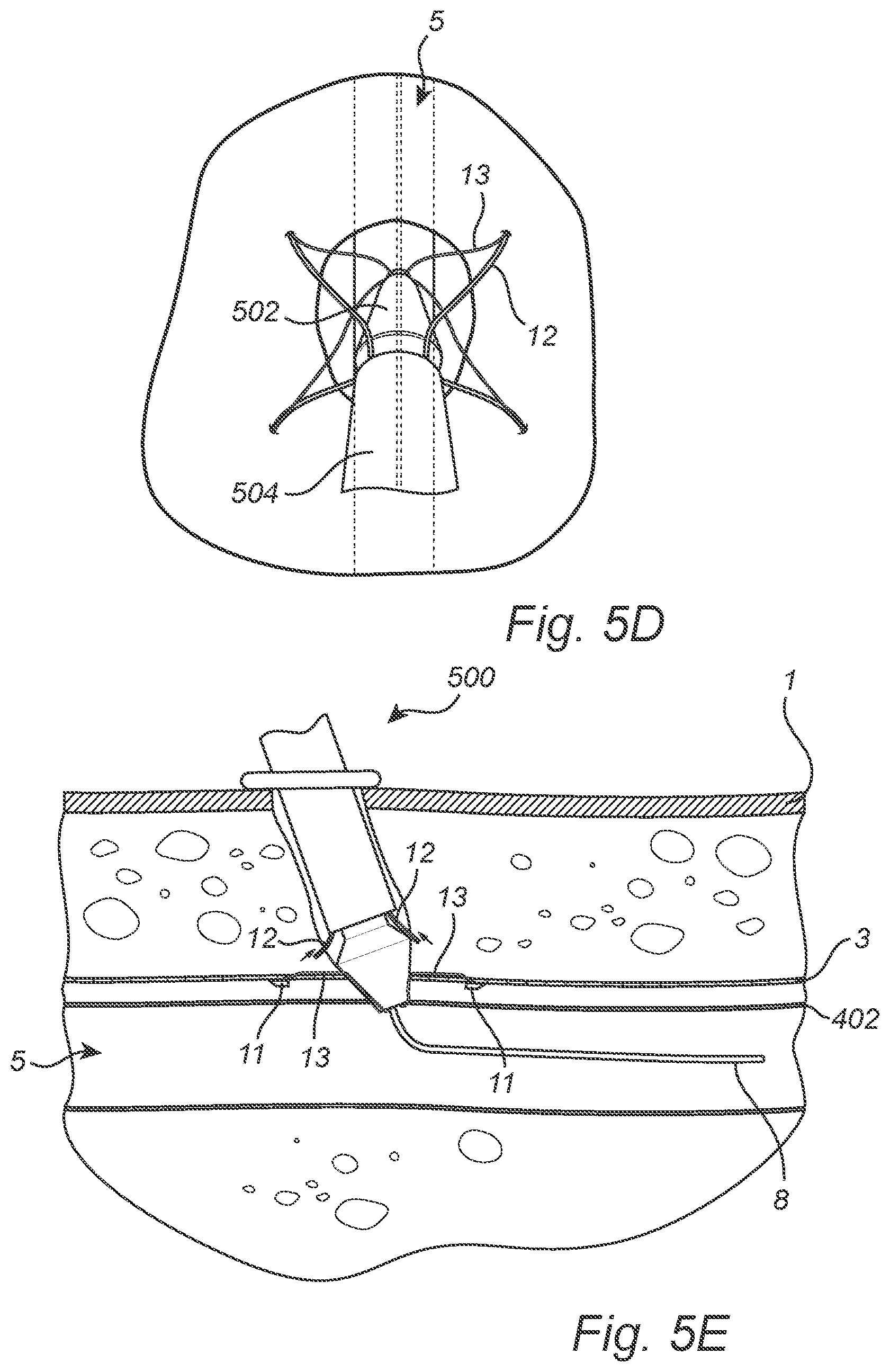 Patent US12508011 Figure 7 – Vascular closure device