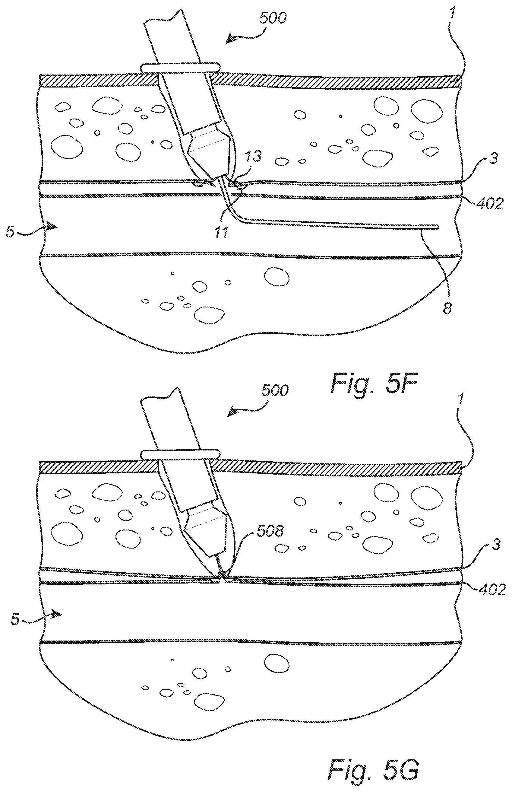 Patent US12508011 Figure 8 – Vascular closure device