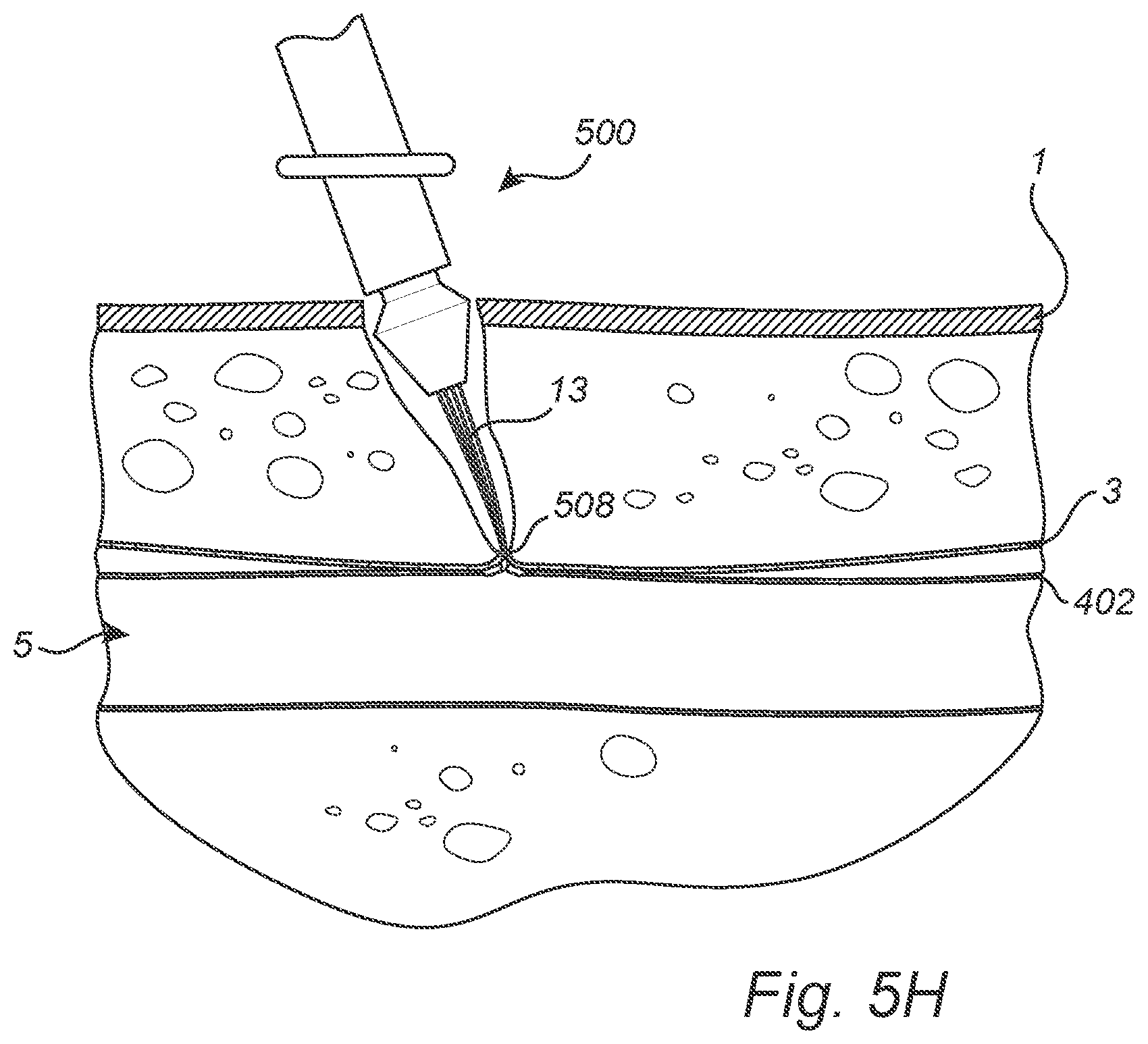 Patent US12508011 Figure 9 – Vascular closure device