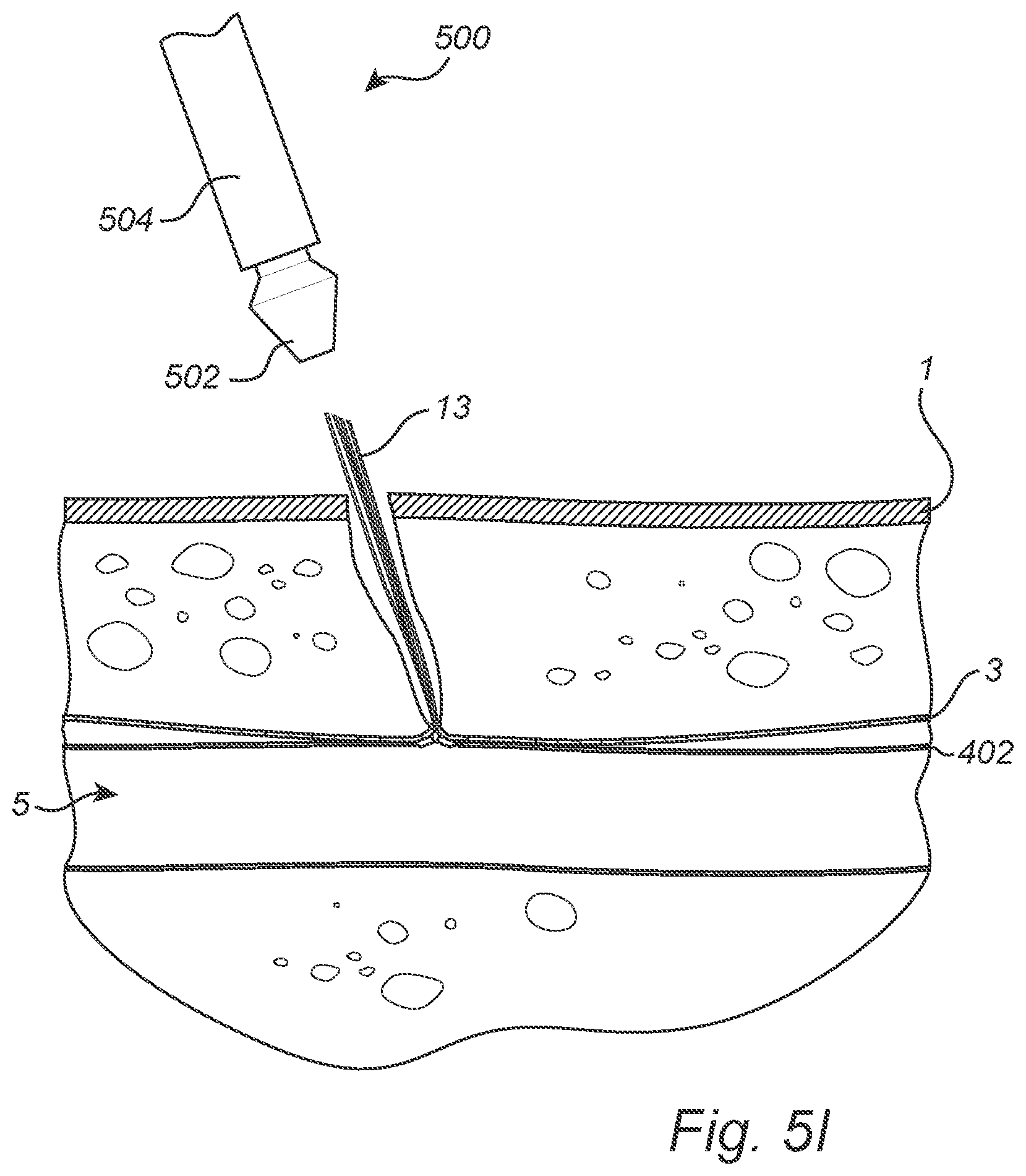 Patent US12508011 Figure 10 – Vascular closure device