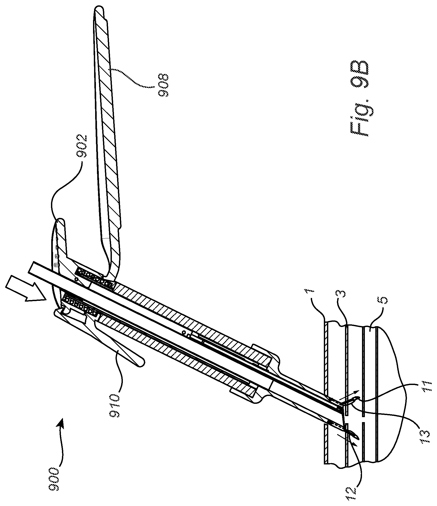Patent US12508011 Figure 17 – Vascular closure device