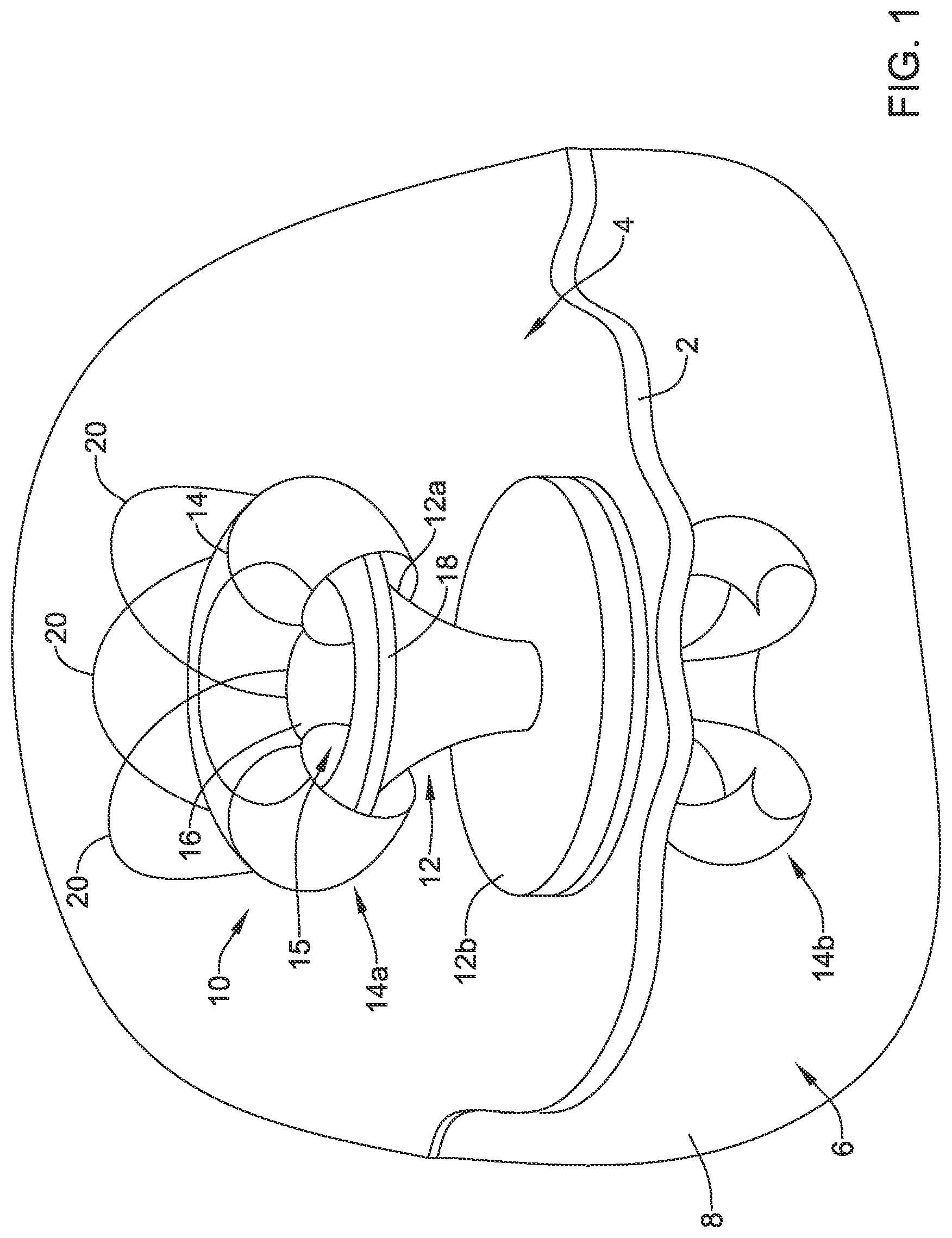 Patent US12508012 Figure 1 – Retrievable access valve